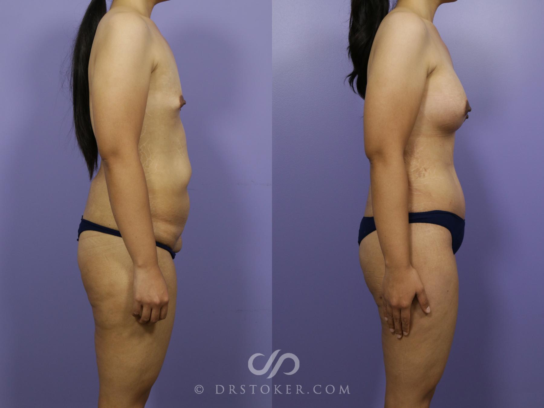 Before & After After Weight Loss Case 656 View #3 View in Los Angeles, CA