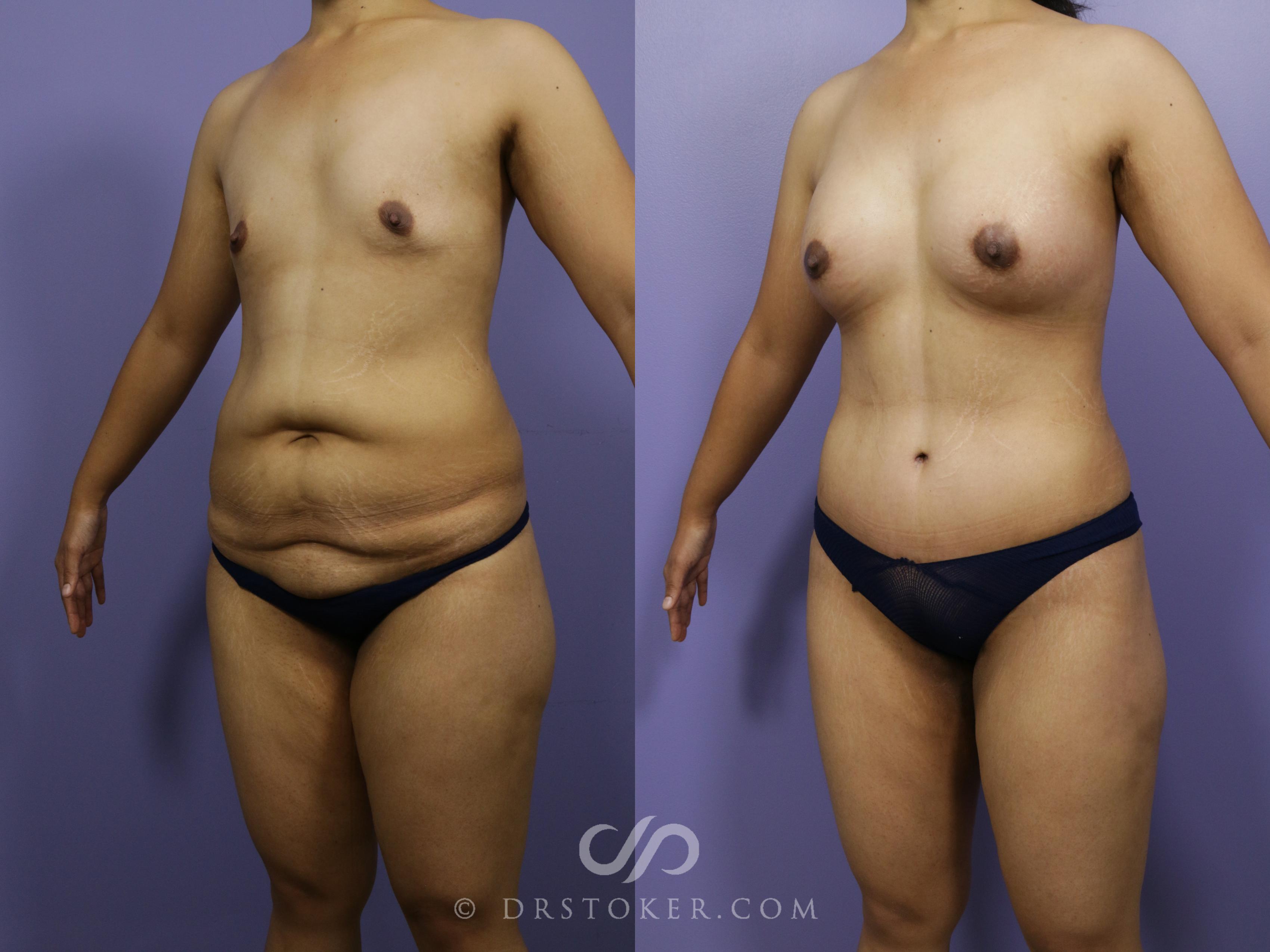 Before & After After Weight Loss Case 656 View #4 View in Los Angeles, CA