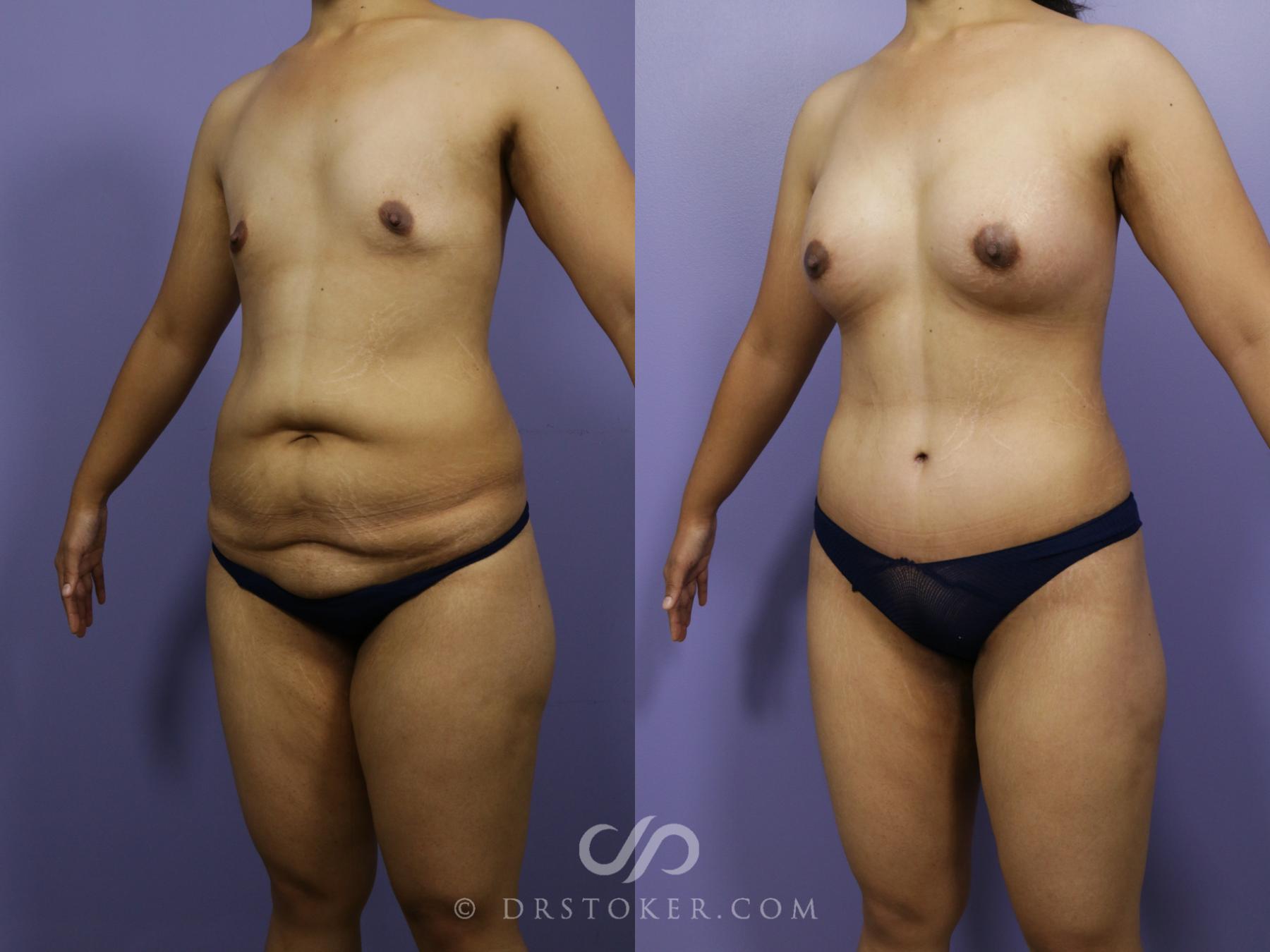 Before & After After Weight Loss Case 656 View #4 View in Los Angeles, CA