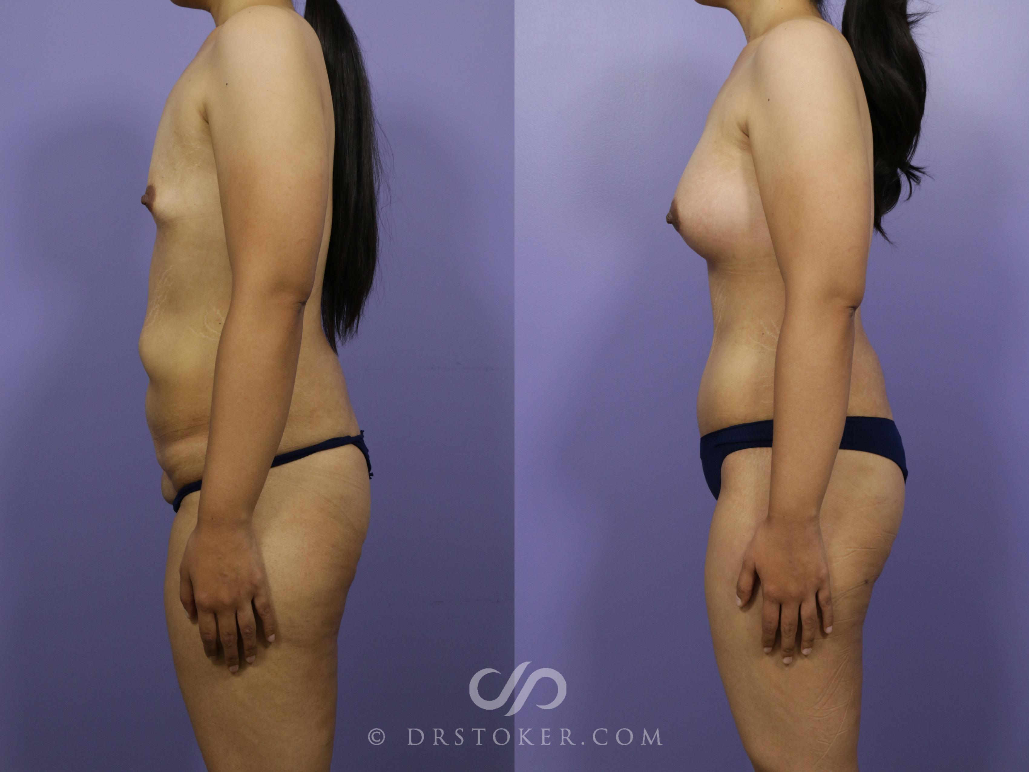 Before & After After Weight Loss Case 656 View #5 View in Los Angeles, CA