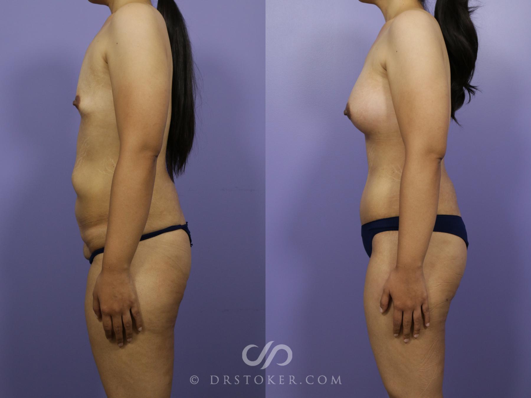 Before & After After Weight Loss Case 656 View #5 View in Los Angeles, CA