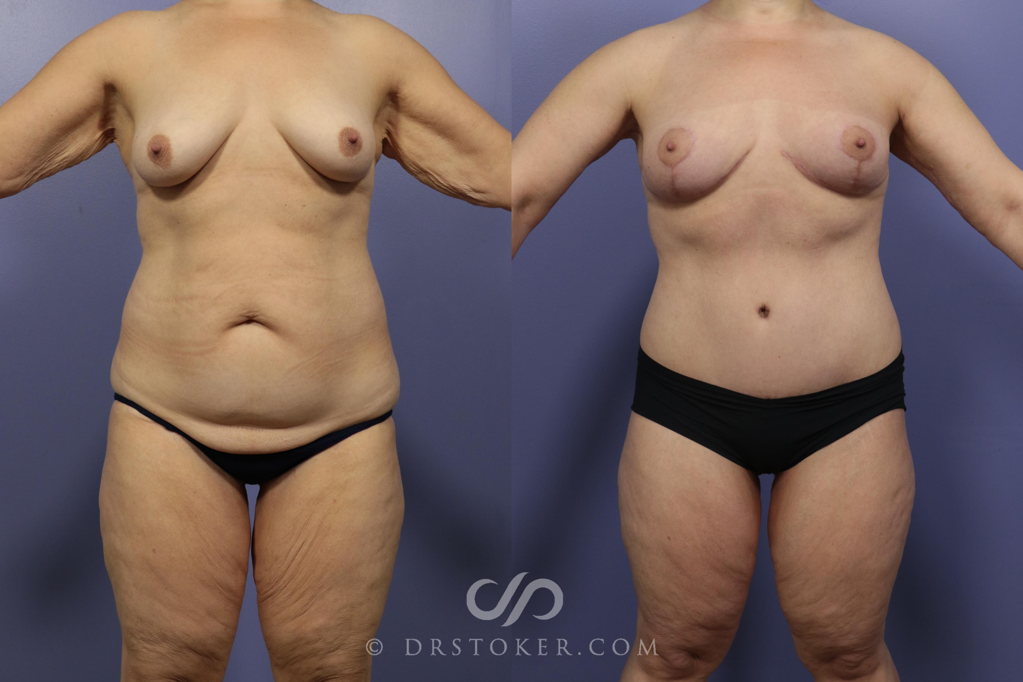 Before & After After Weight Loss Case 658 View #1 View in Los Angeles, CA