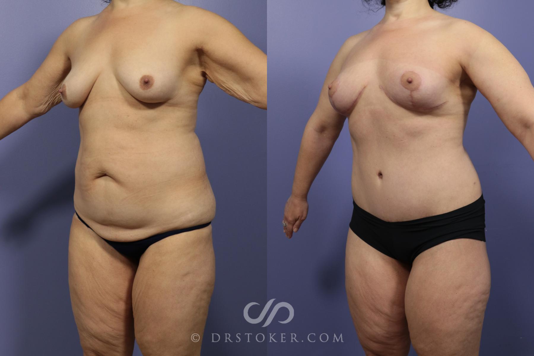 Before & After After Weight Loss Case 658 View #2 View in Los Angeles, CA
