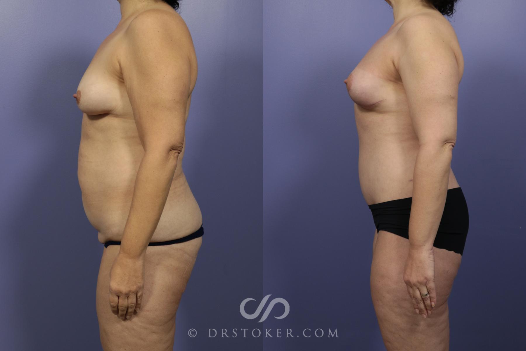 Before & After After Weight Loss Case 658 View #3 View in Los Angeles, CA
