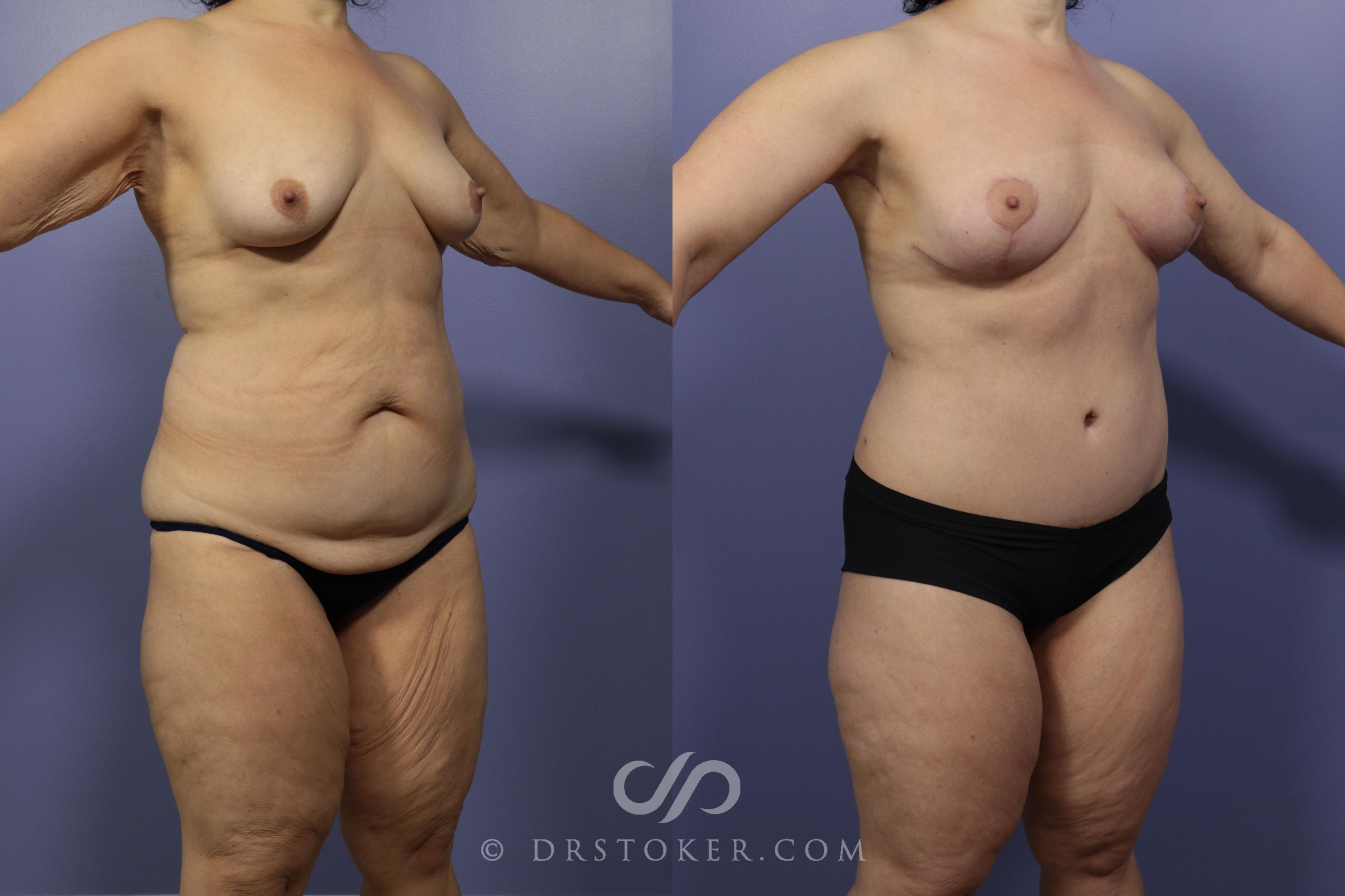 Before & After After Weight Loss Case 659 View #1 View in Los Angeles, CA