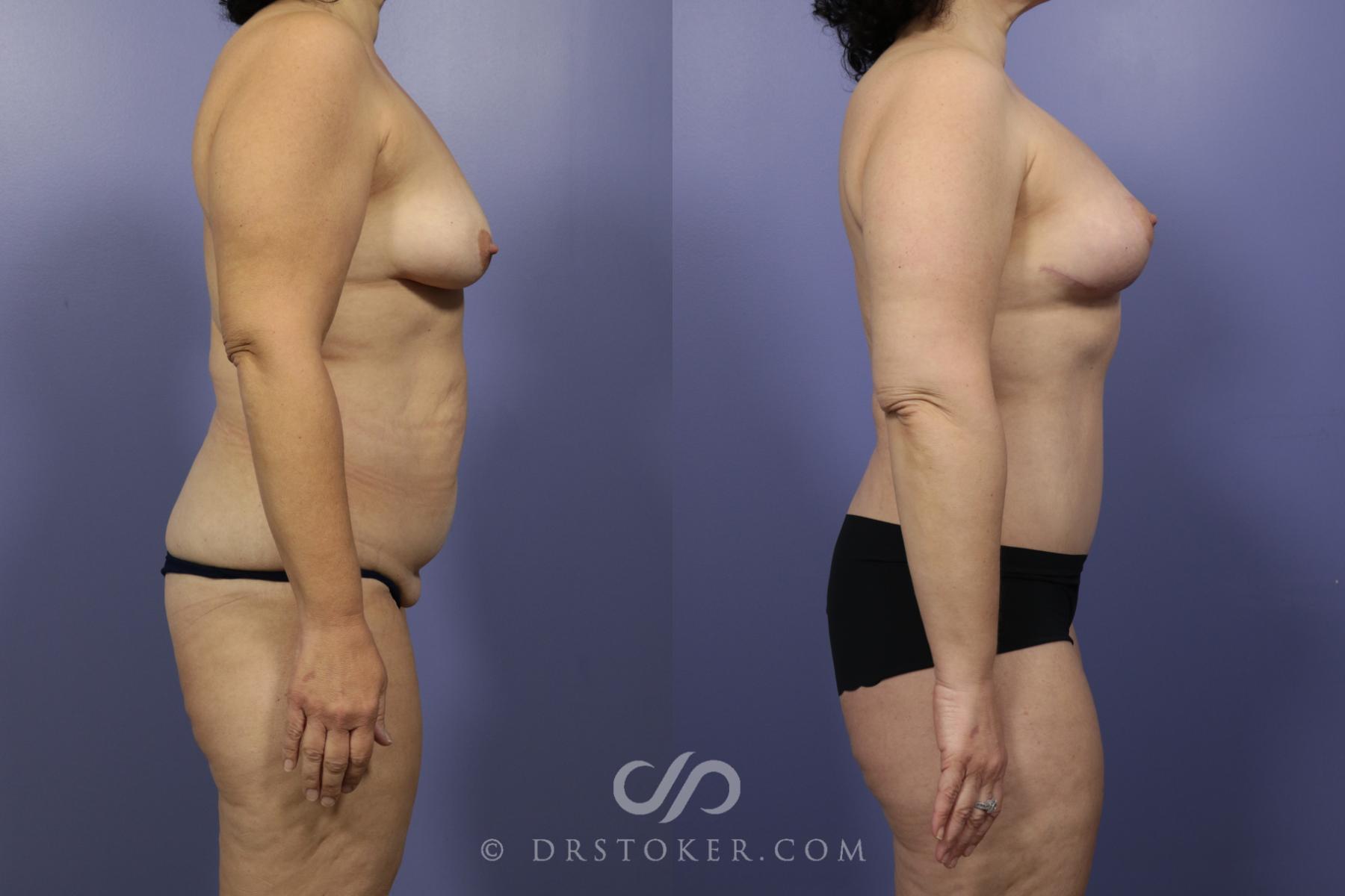Before & After After Weight Loss Case 659 View #2 View in Los Angeles, CA