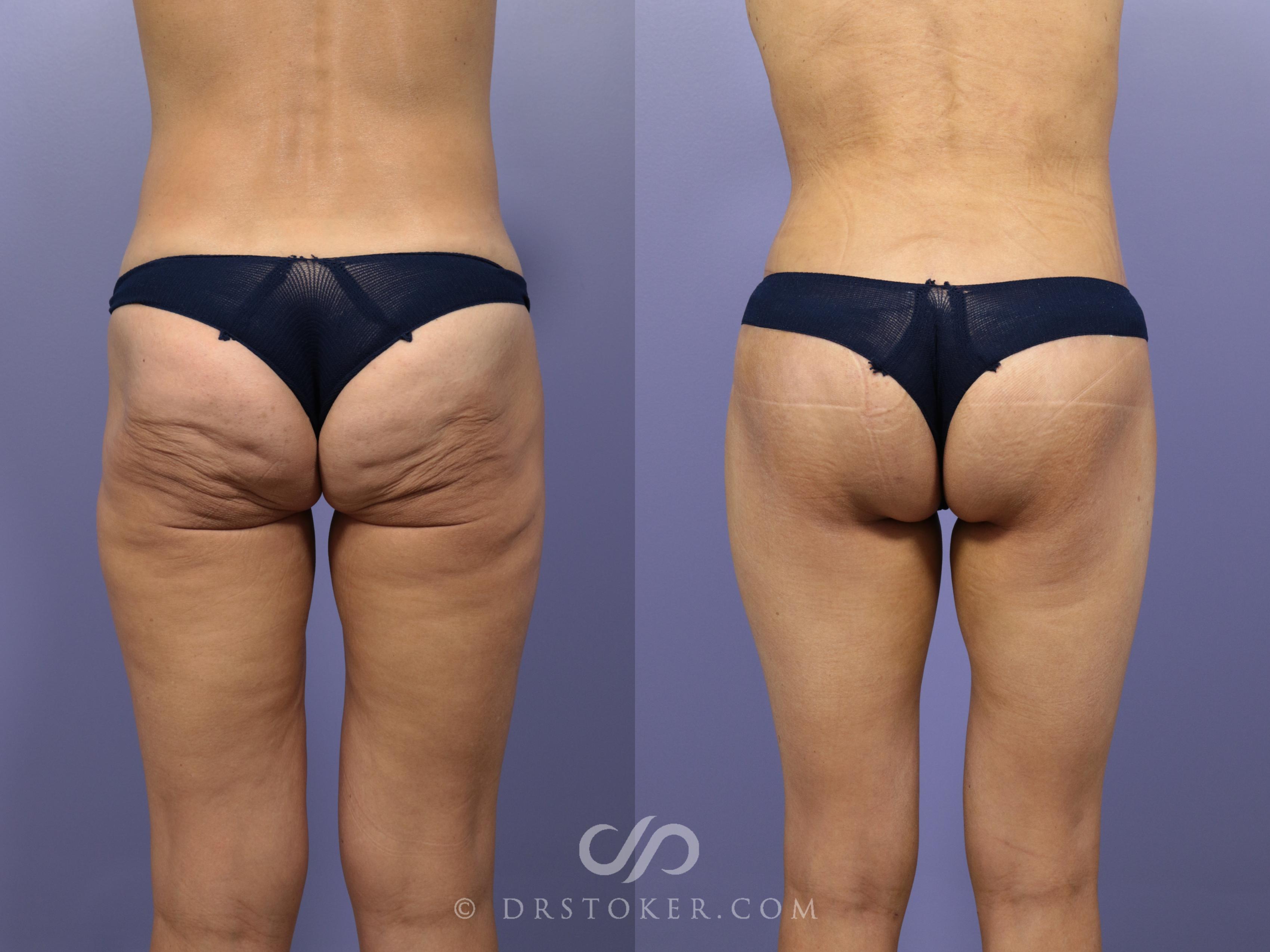 Before & After After Weight Loss Case 660 View #1 View in Los Angeles, CA