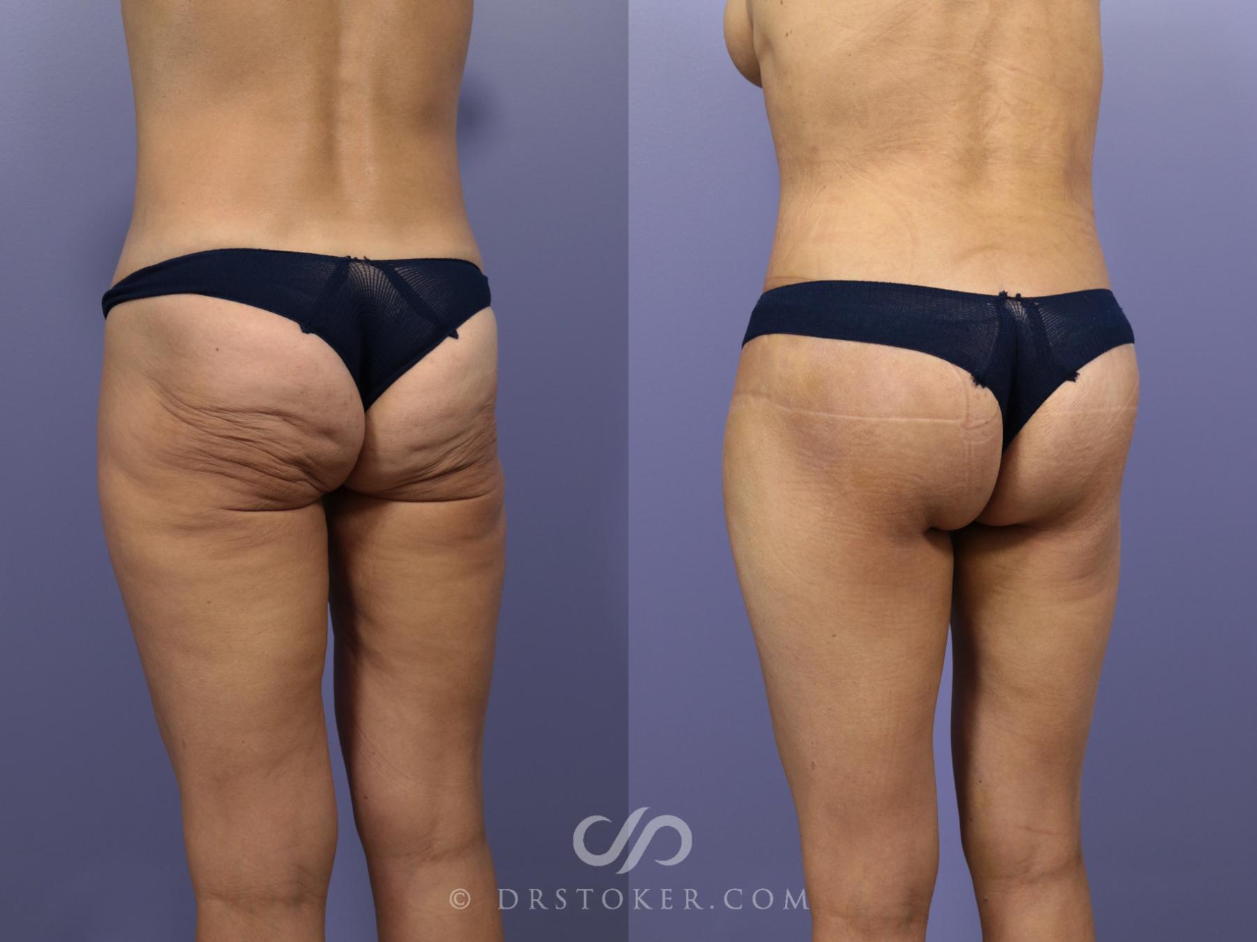 Before & After After Weight Loss Case 660 View #2 View in Los Angeles, CA