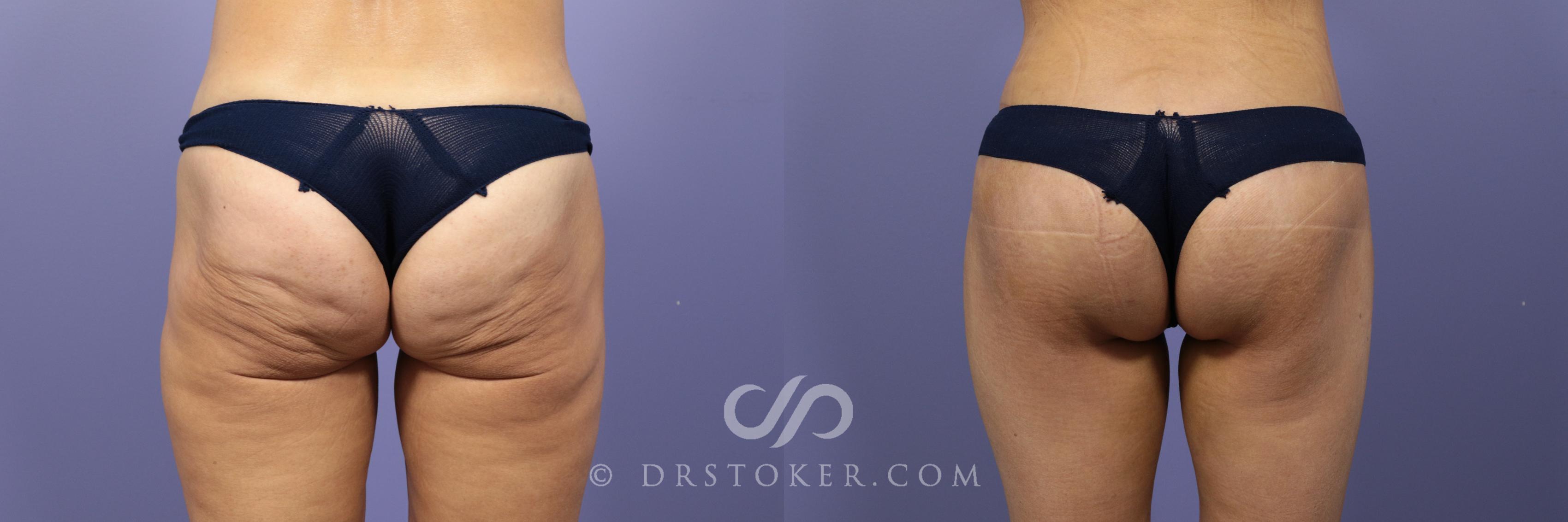 Before & After After Weight Loss Case 661 View #1 View in Los Angeles, CA