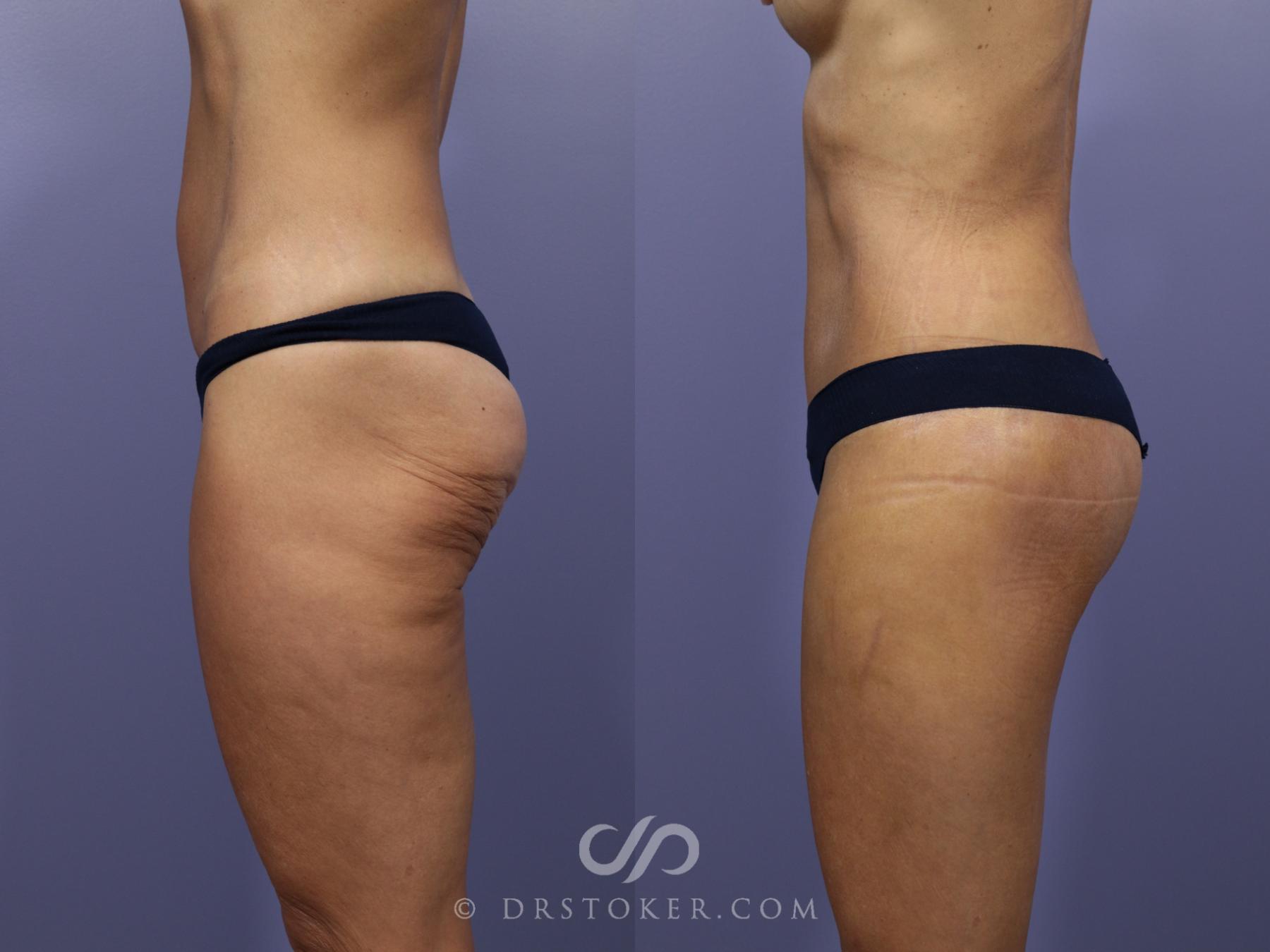 Before & After After Weight Loss Case 661 View #2 View in Los Angeles, CA