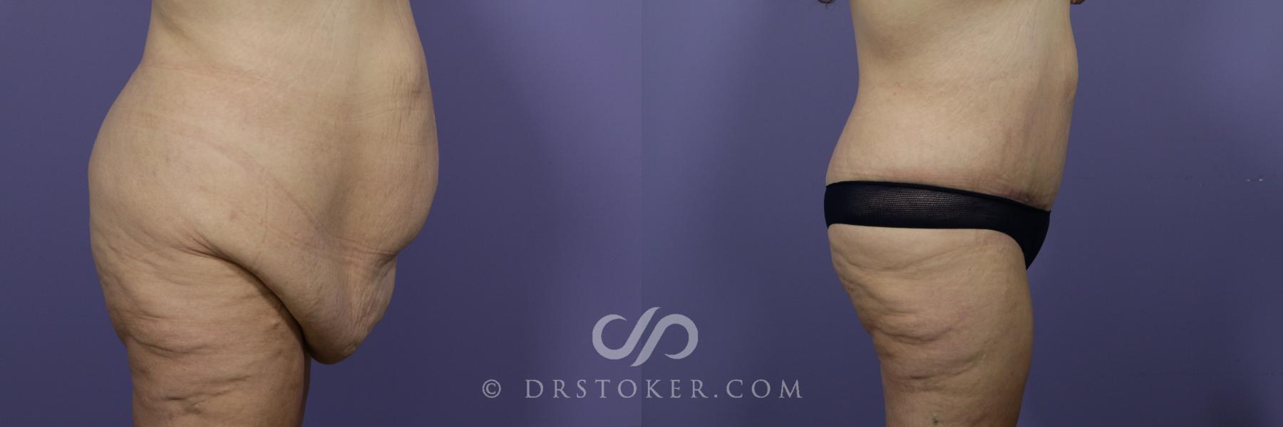 Before & After After Weight Loss Case 662 View #2 View in Los Angeles, CA