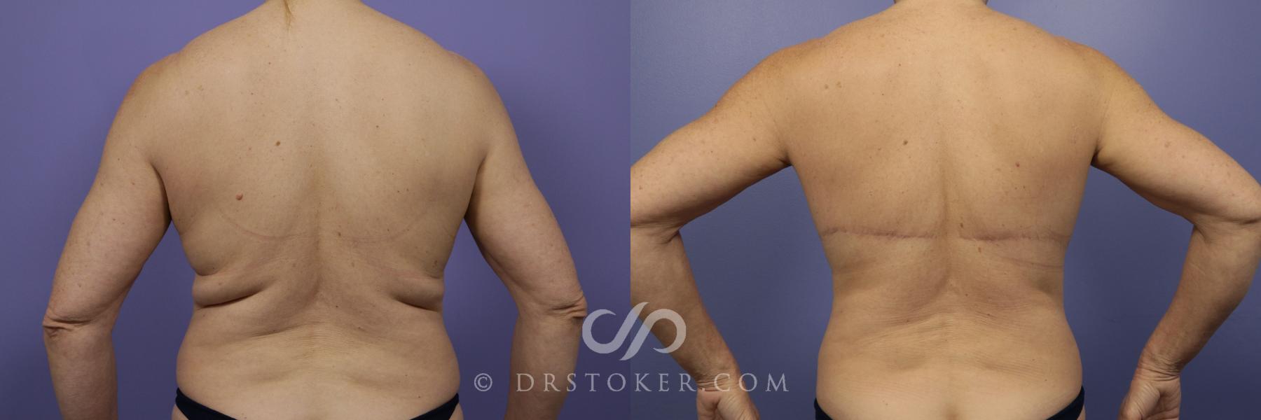 Before & After After Weight Loss Case 663 View #1 View in Los Angeles, CA