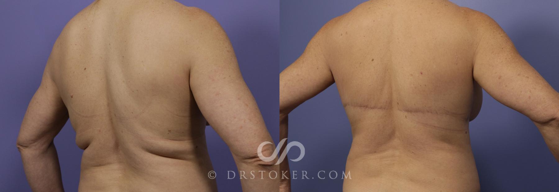 Before & After After Weight Loss Case 663 View #3 View in Los Angeles, CA