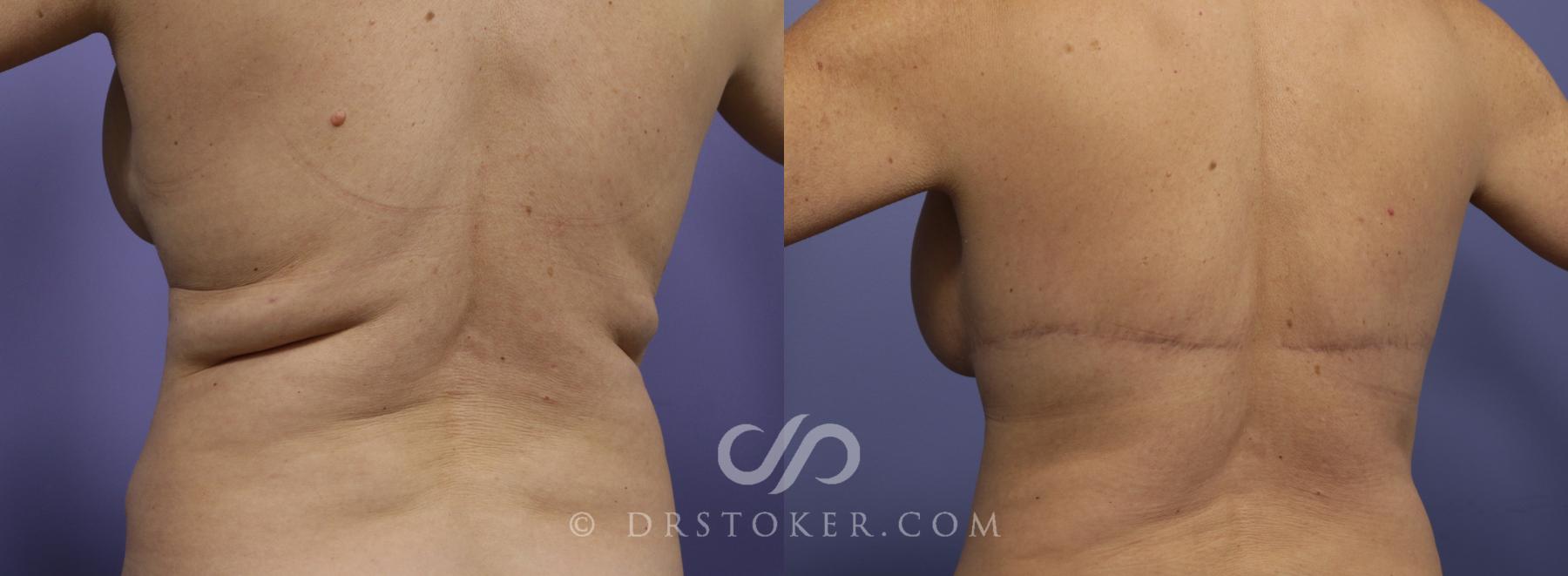 Before & After After Weight Loss Case 665 View #2 View in Los Angeles, CA
