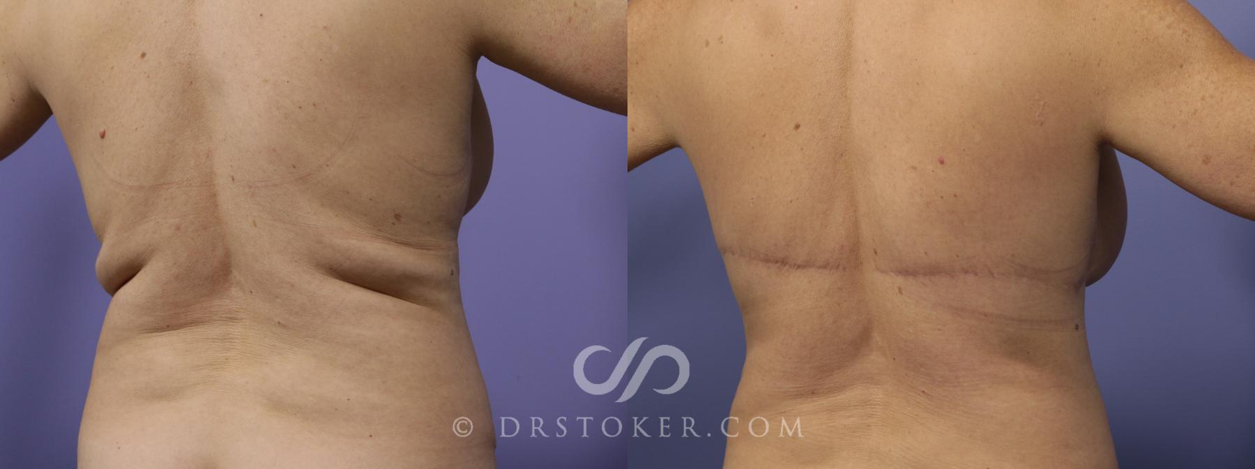 Before & After After Weight Loss Case 665 View #3 View in Los Angeles, CA