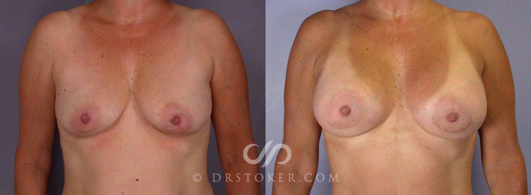 Before & After Tummy Tuck Case 67 View #10 View in Los Angeles, CA