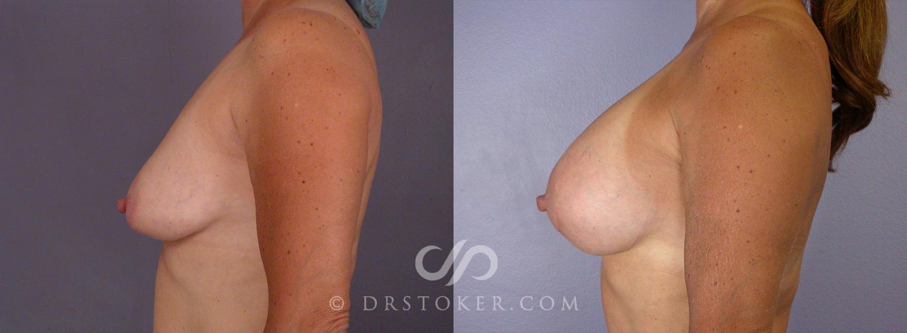 Before & After Tummy Tuck Case 67 View #11 View in Los Angeles, CA