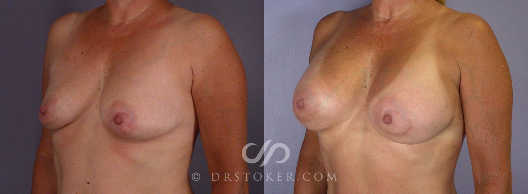 Before & After Tummy Tuck Case 67 View #12 View in Los Angeles, CA