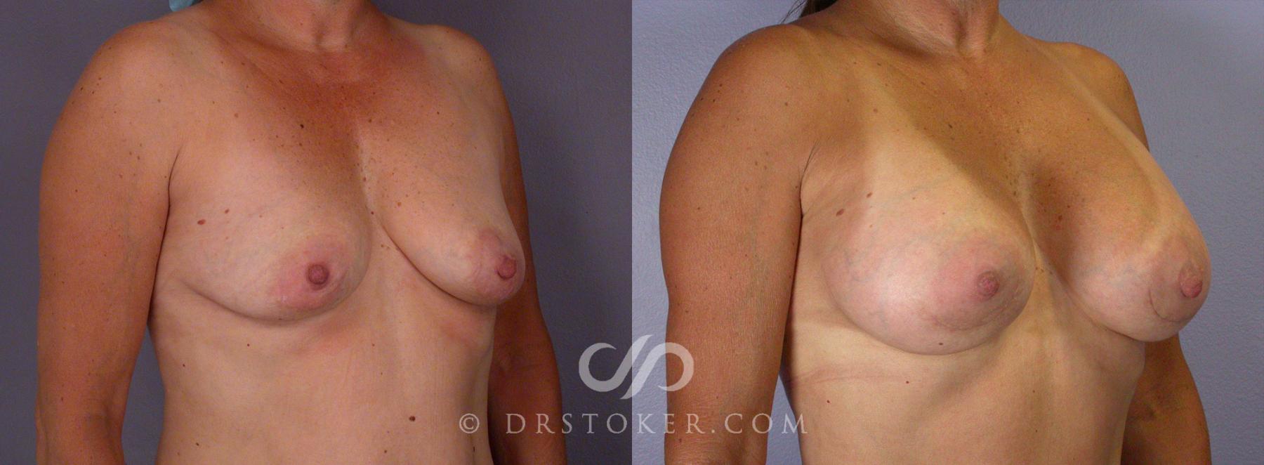 Before & After Tummy Tuck Case 67 View #13 View in Los Angeles, CA