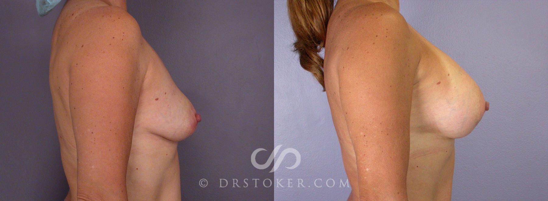 Before & After Tummy Tuck Case 67 View #14 View in Los Angeles, CA