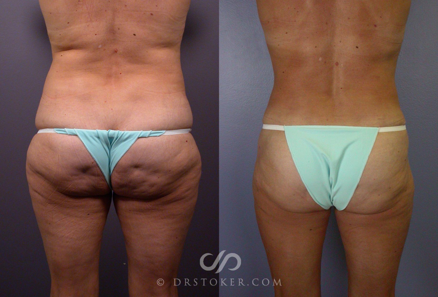 Before & After Tummy Tuck Case 67 View #2 View in Los Angeles, CA