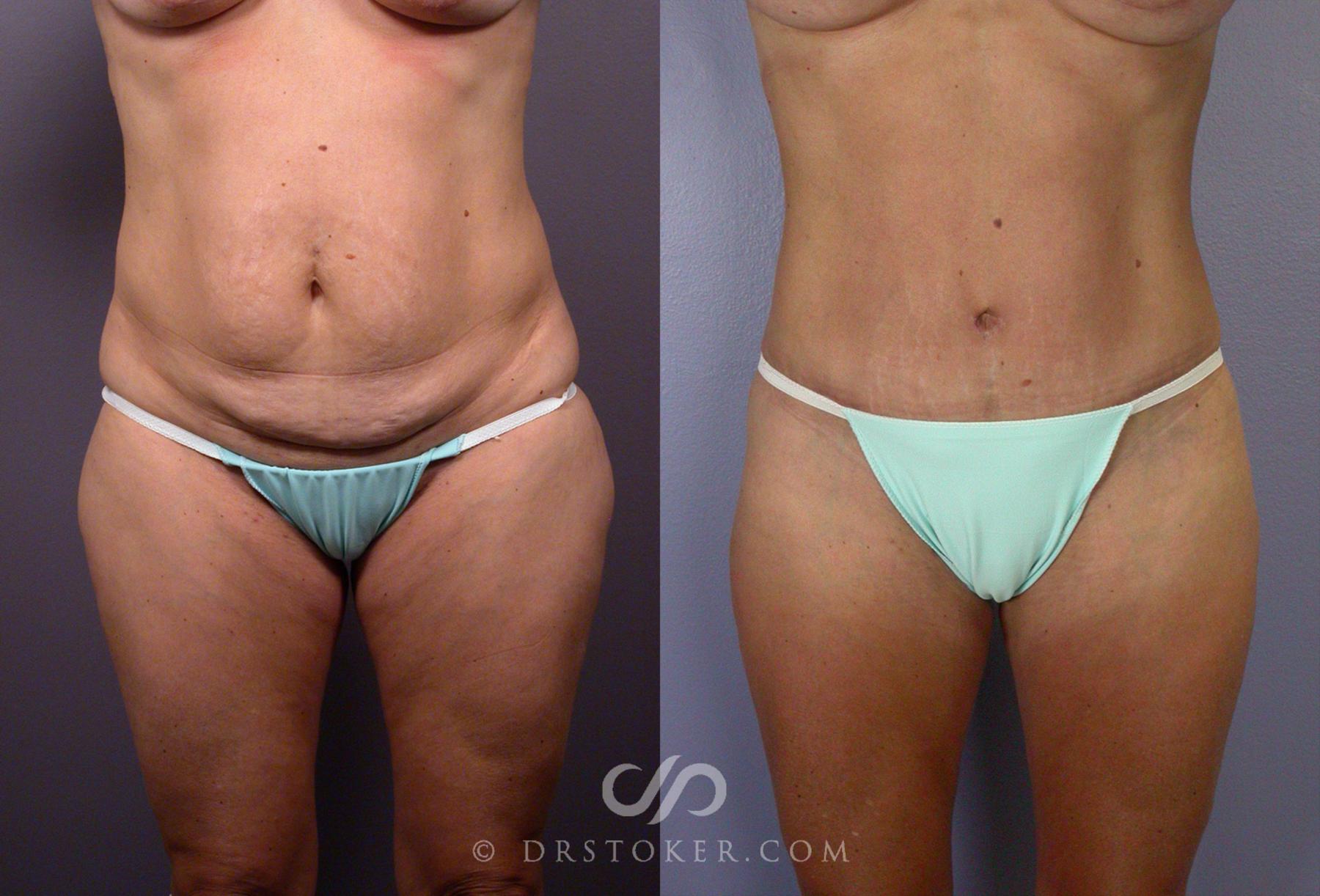 Before & After After Weight Loss Case 67 View #3 View in Los Angeles, CA