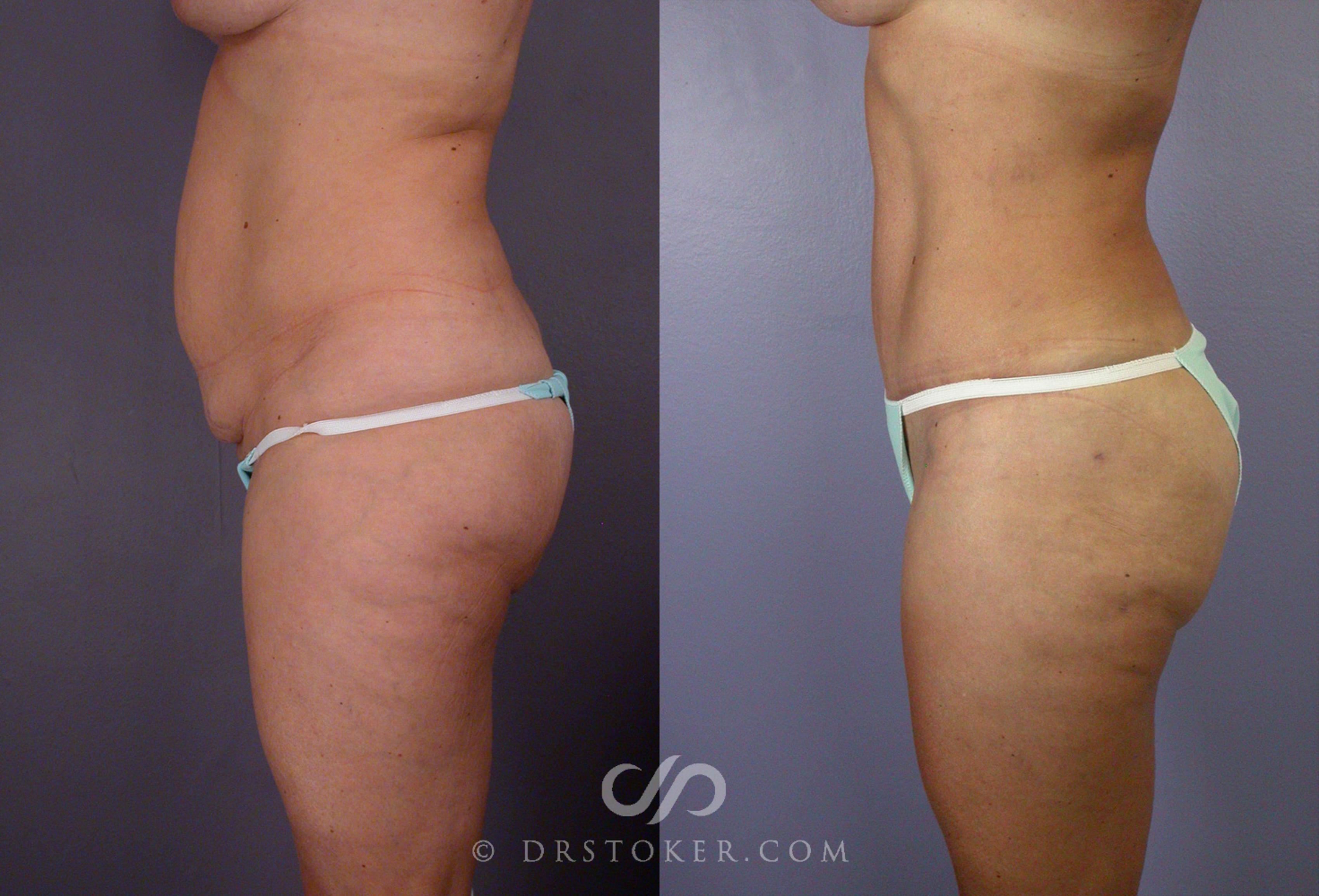 Before & After After Weight Loss Case 67 View #4 View in Los Angeles, CA