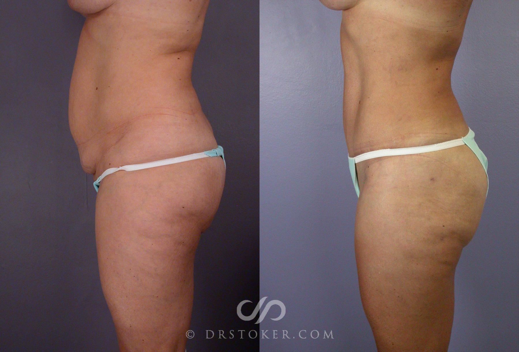 Before & After After Weight Loss Case 67 View #4 View in Los Angeles, CA