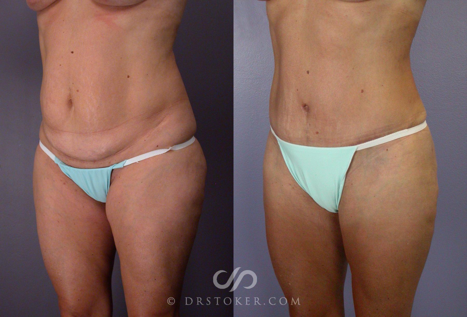 Before & After After Weight Loss Case 67 View #5 View in Los Angeles, CA