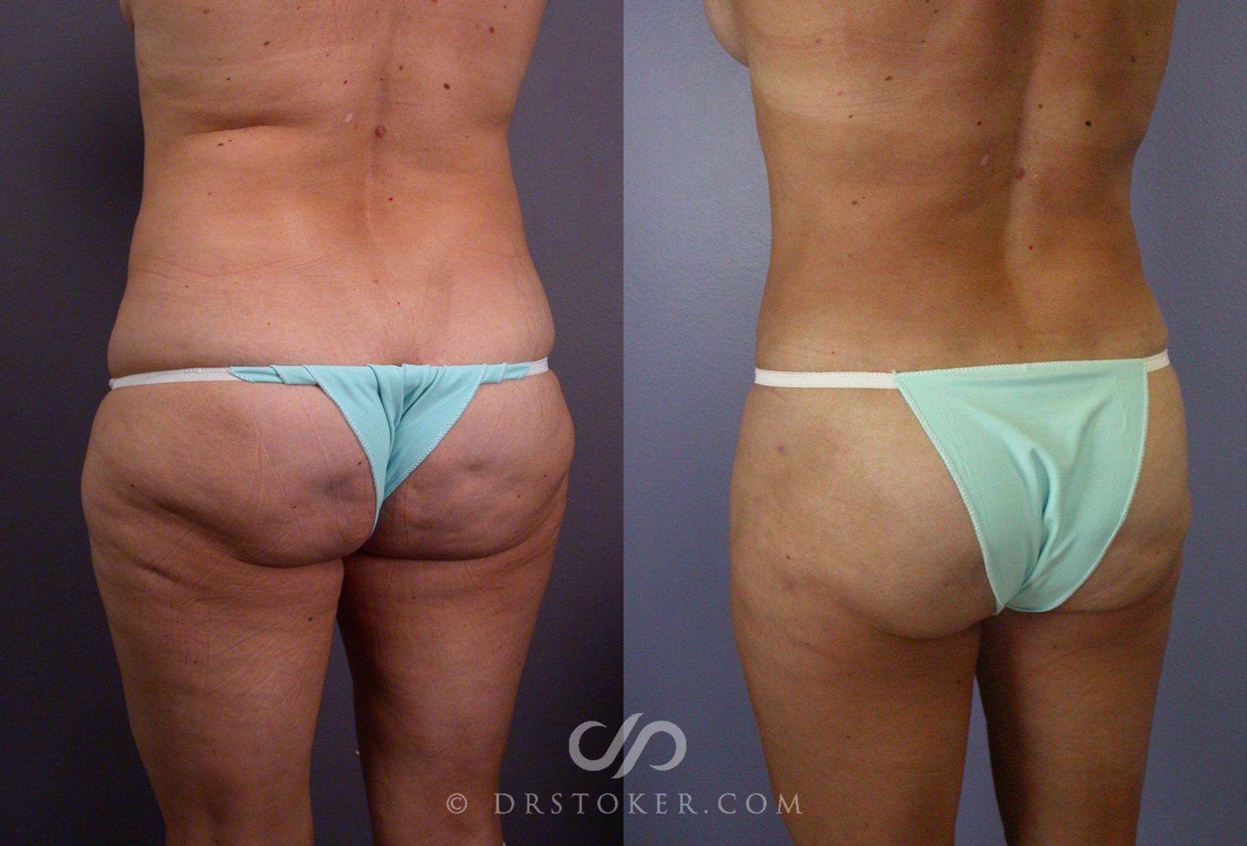 Before & After Tummy Tuck Case 67 View #6 View in Los Angeles, CA