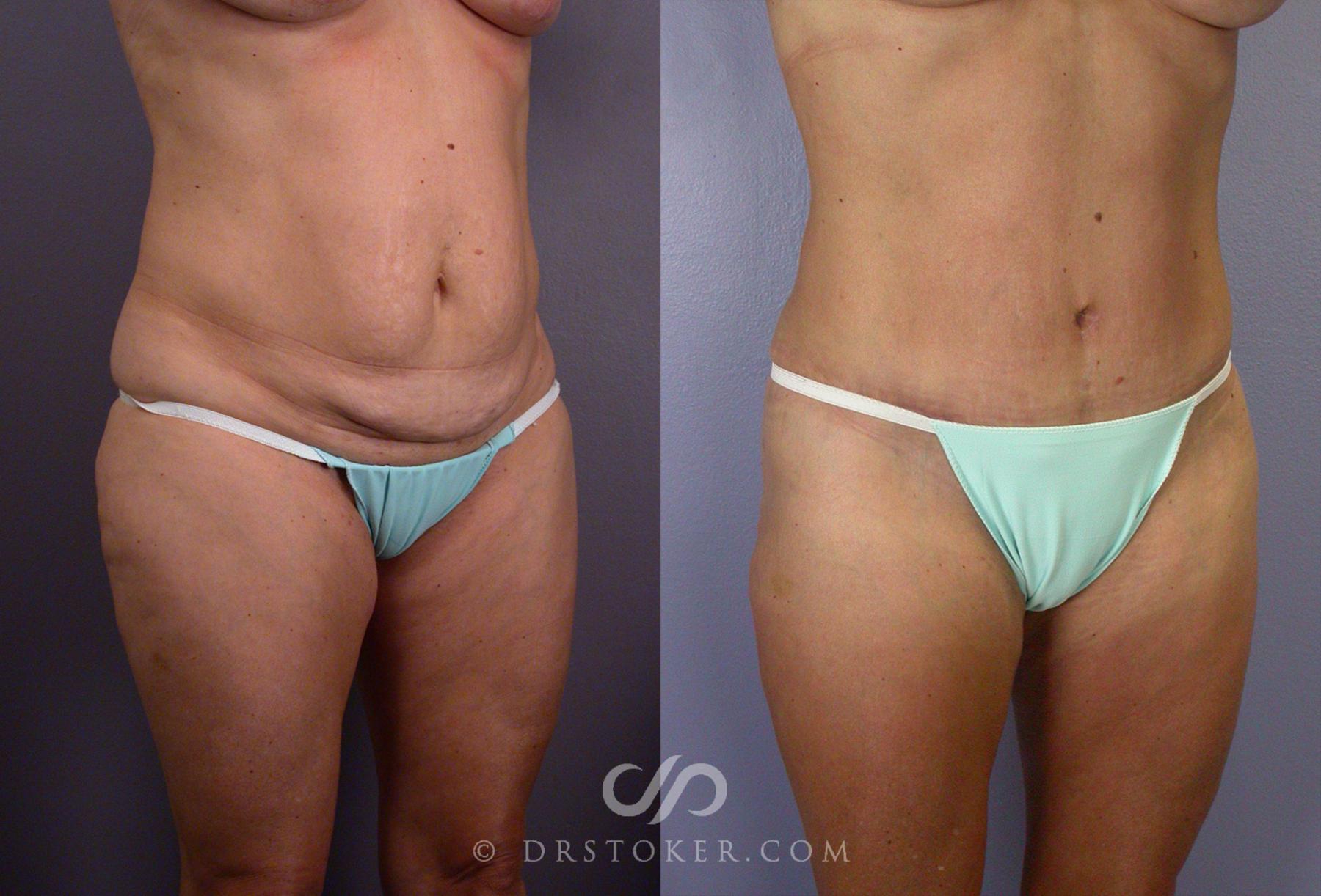 Before & After Tummy Tuck Case 67 View #7 View in Los Angeles, CA