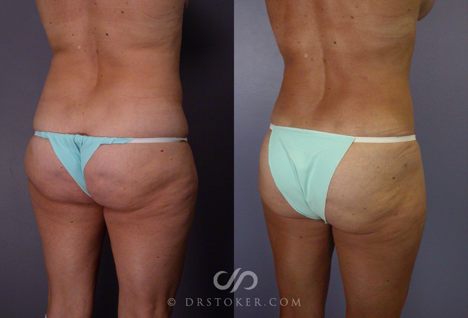 Before & After Tummy Tuck Case 67 View #8 View in Los Angeles, CA
