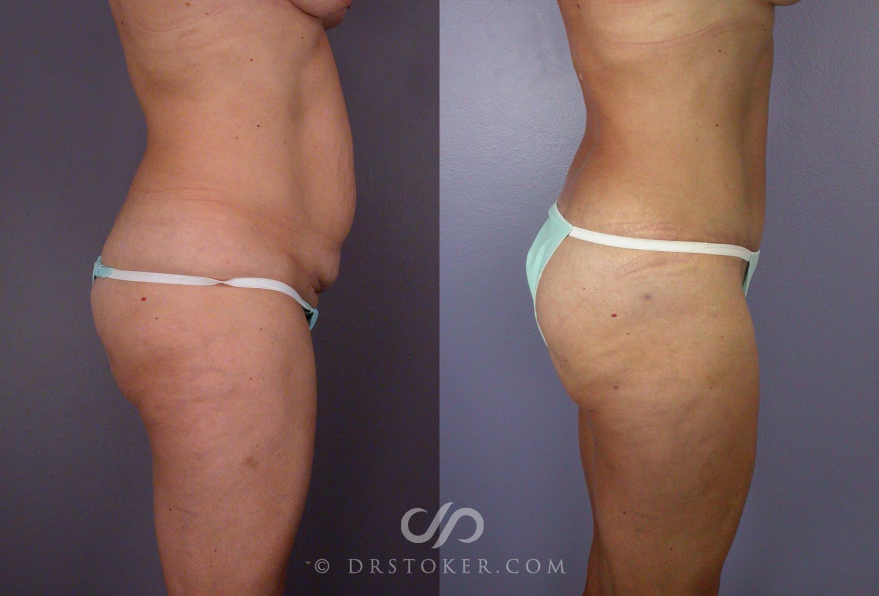 Before & After After Weight Loss Case 67 View #9 View in Los Angeles, CA