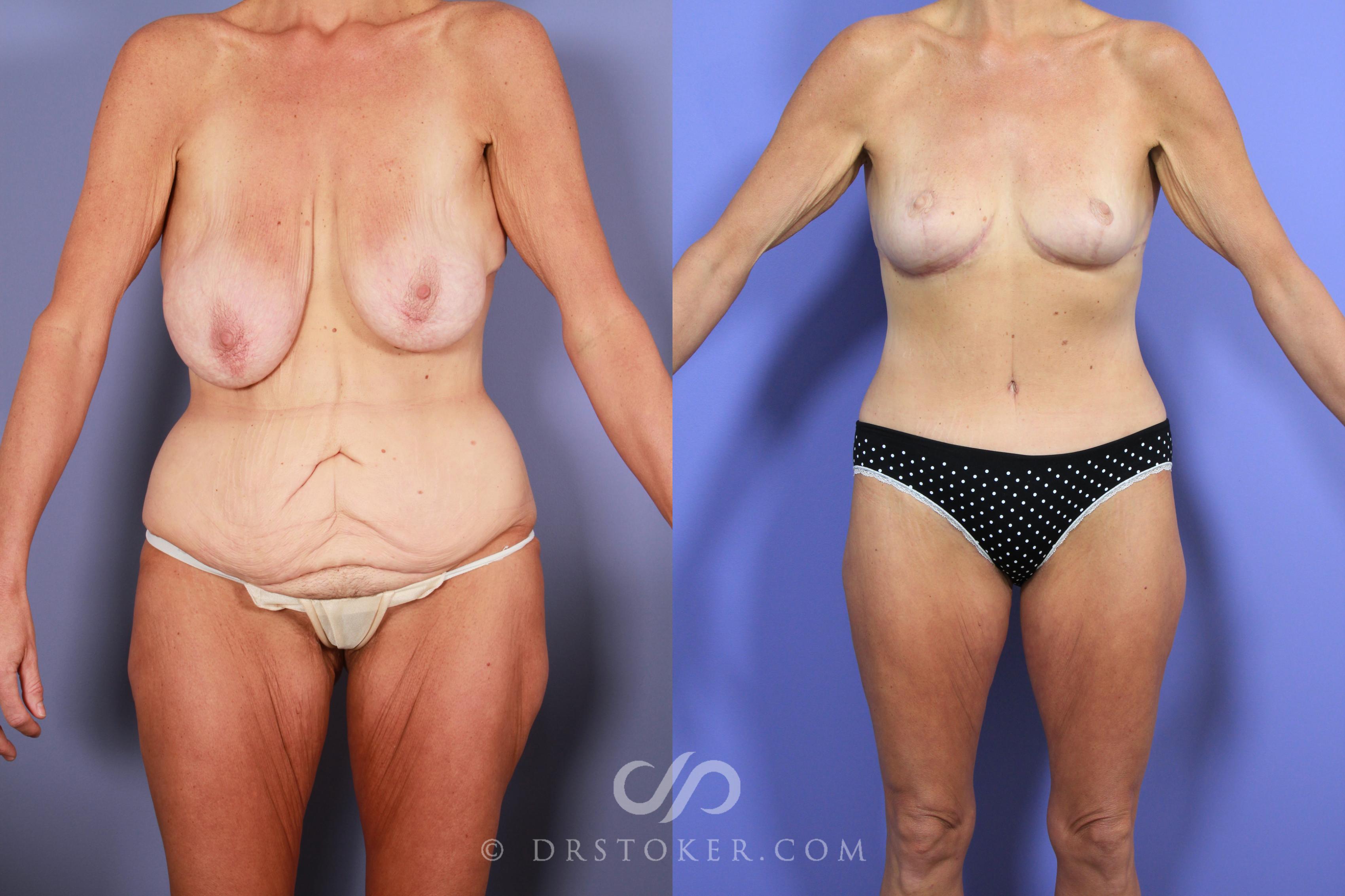 Before & After After Weight Loss Case 726 View #1 View in Los Angeles, CA
