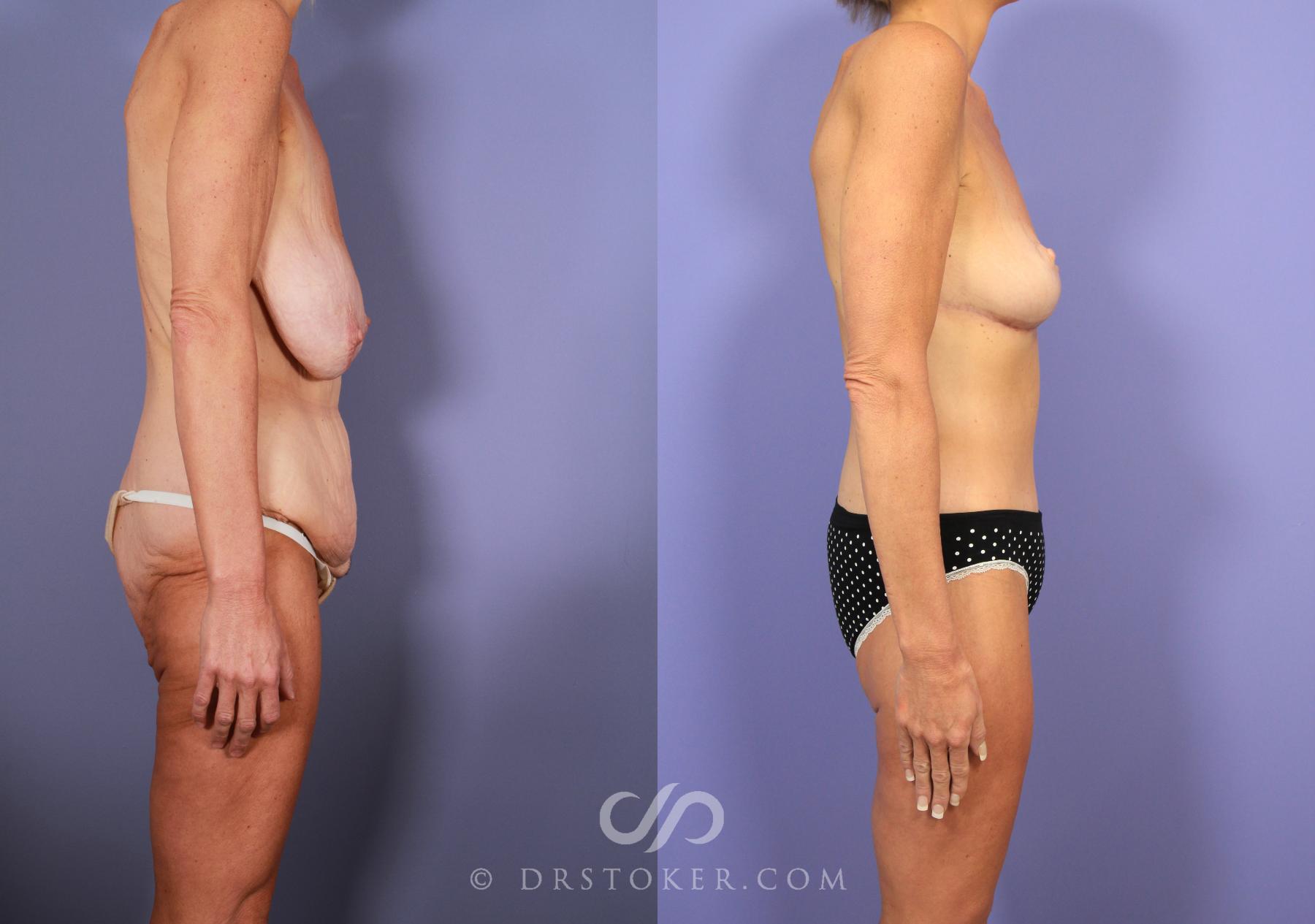 Before & After After Weight Loss Case 726 View #2 View in Los Angeles, CA