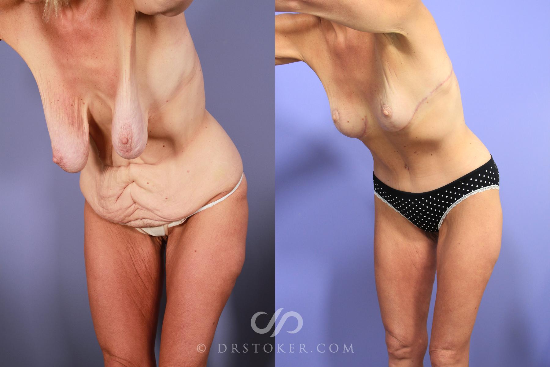 Before & After After Weight Loss Case 733 View #1 View in Los Angeles, CA