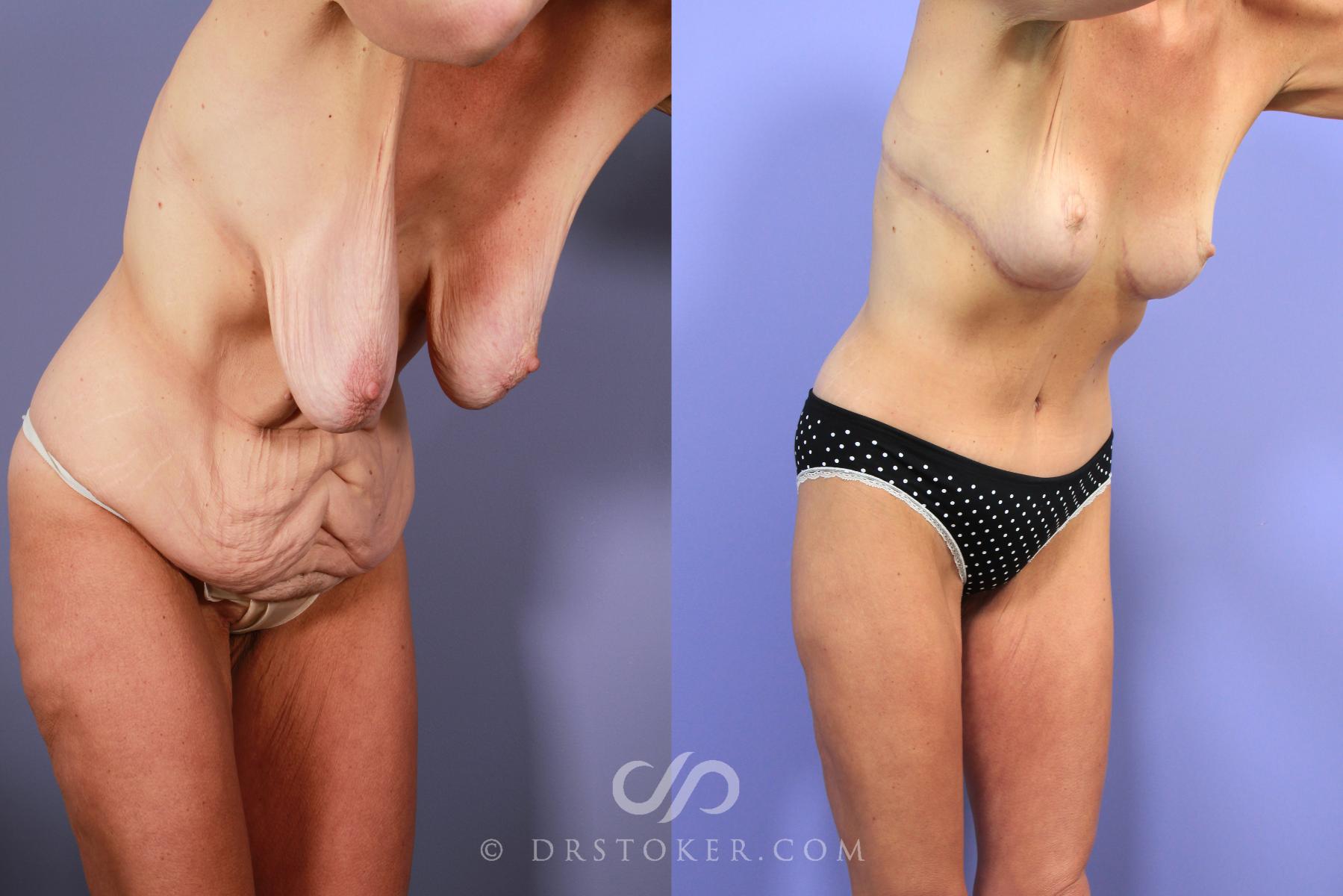 Before & After After Weight Loss Case 733 View #3 View in Los Angeles, CA