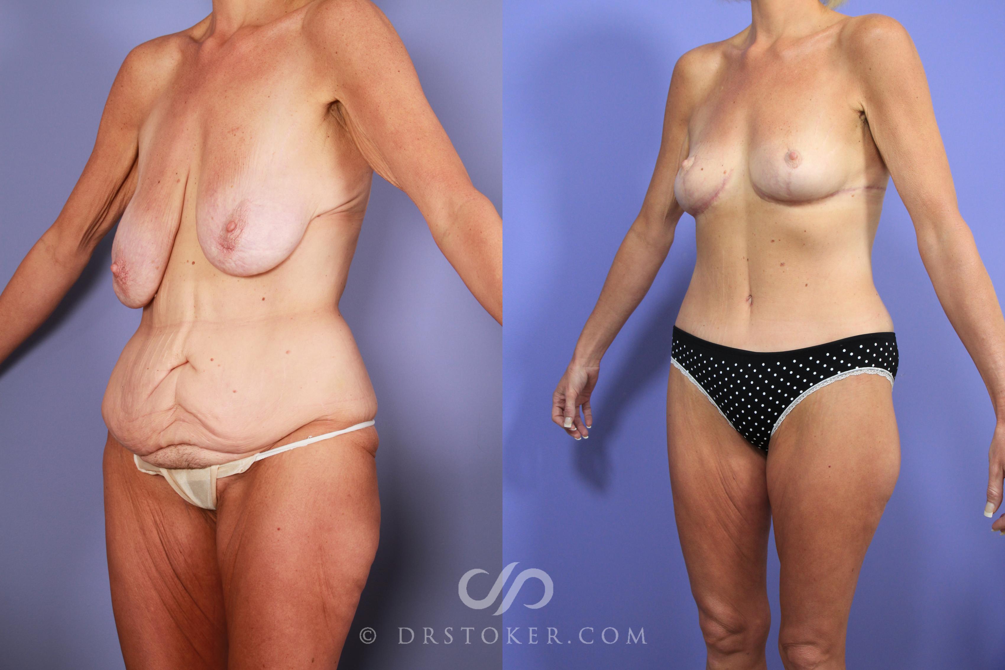 Before & After After Weight Loss Case 735 View #1 View in Los Angeles, CA