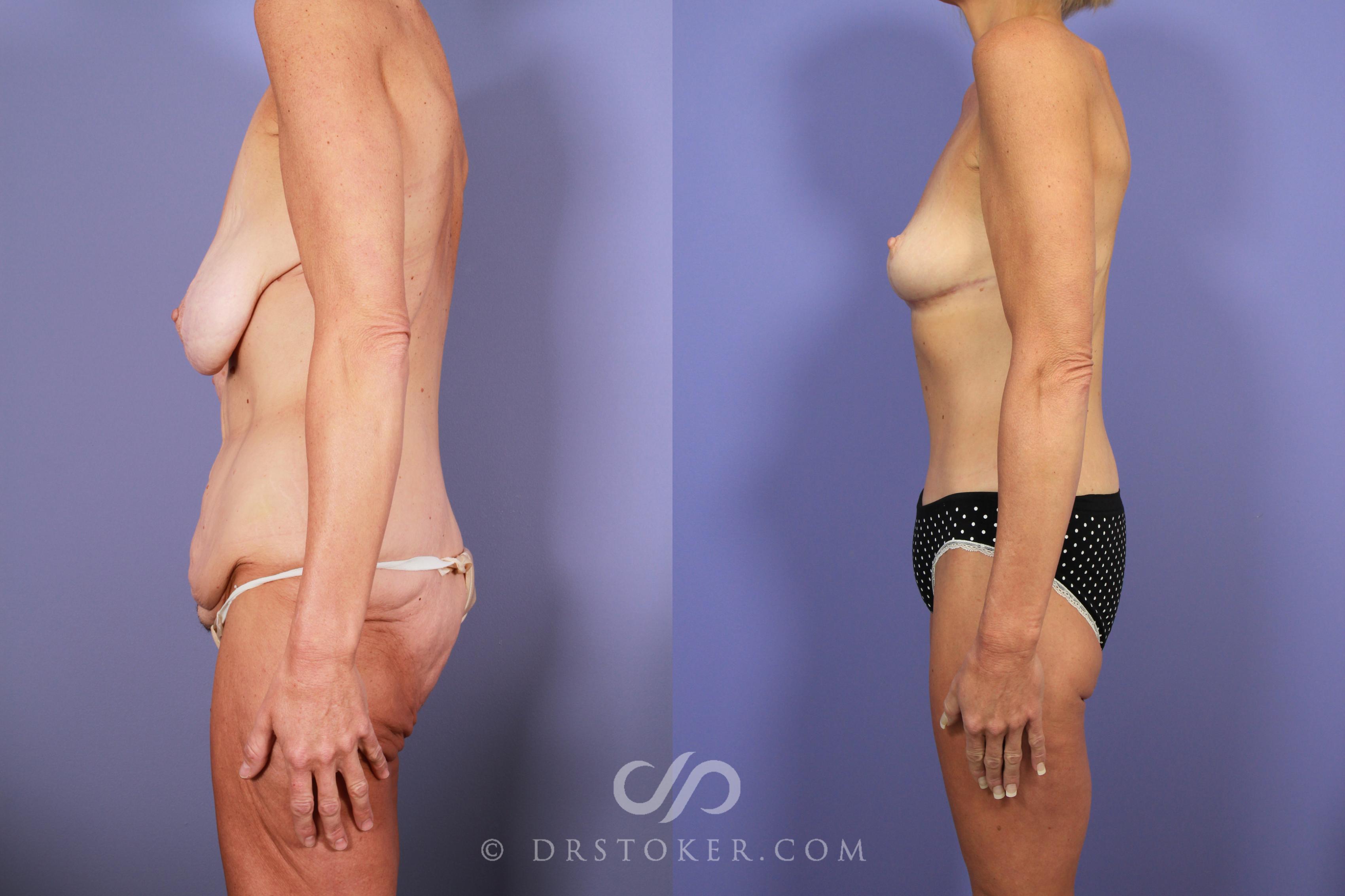 Before & After After Weight Loss Case 735 View #2 View in Los Angeles, CA