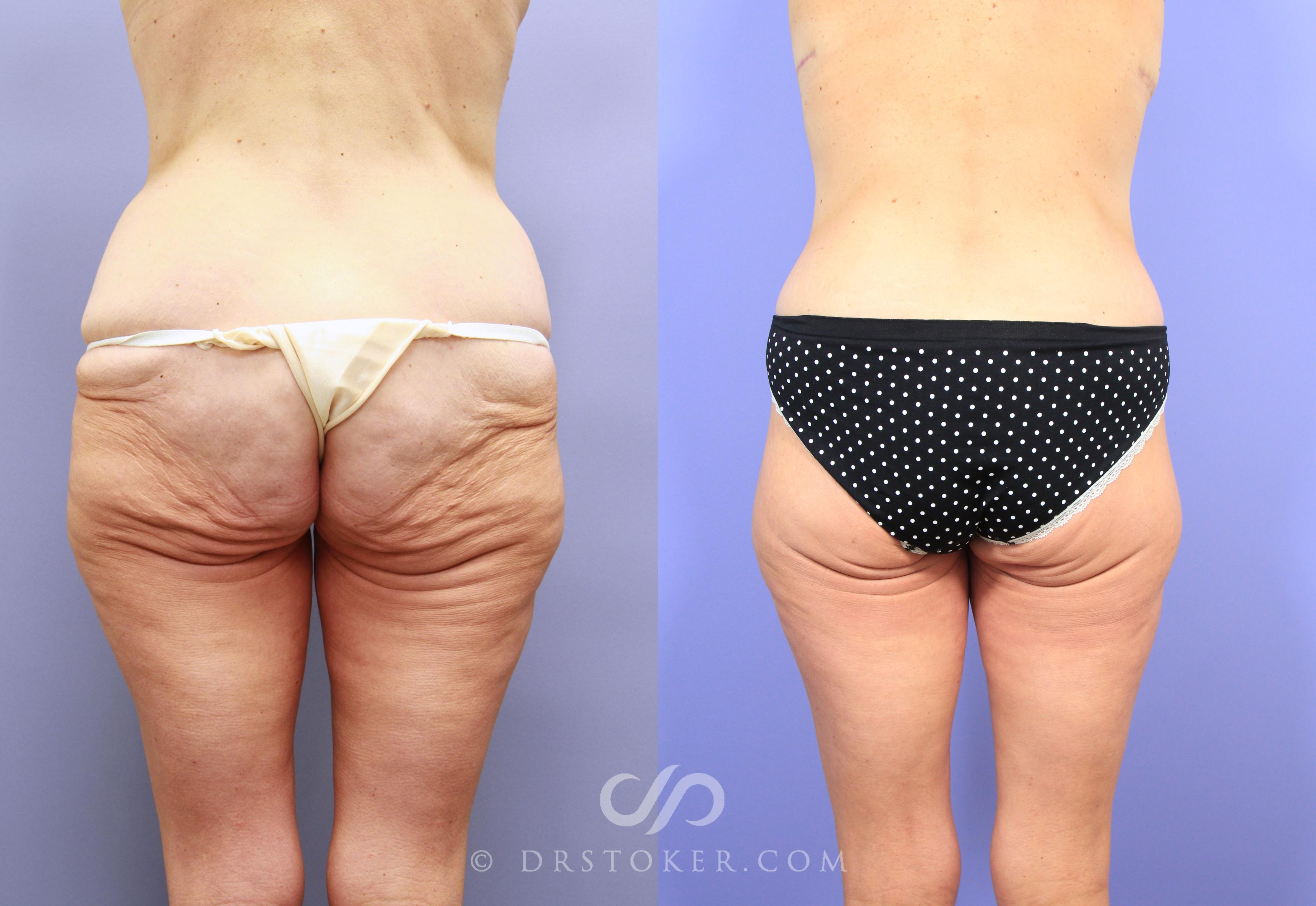 Before & After After Weight Loss Case 738 View #1 View in Los Angeles, CA