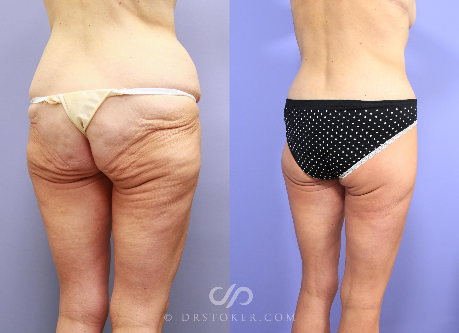 Before & After After Weight Loss Case 738 View #2 View in Los Angeles, CA