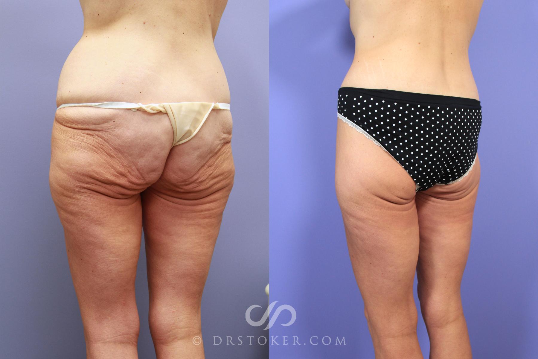 Before & After After Weight Loss Case 738 View #3 View in Los Angeles, CA