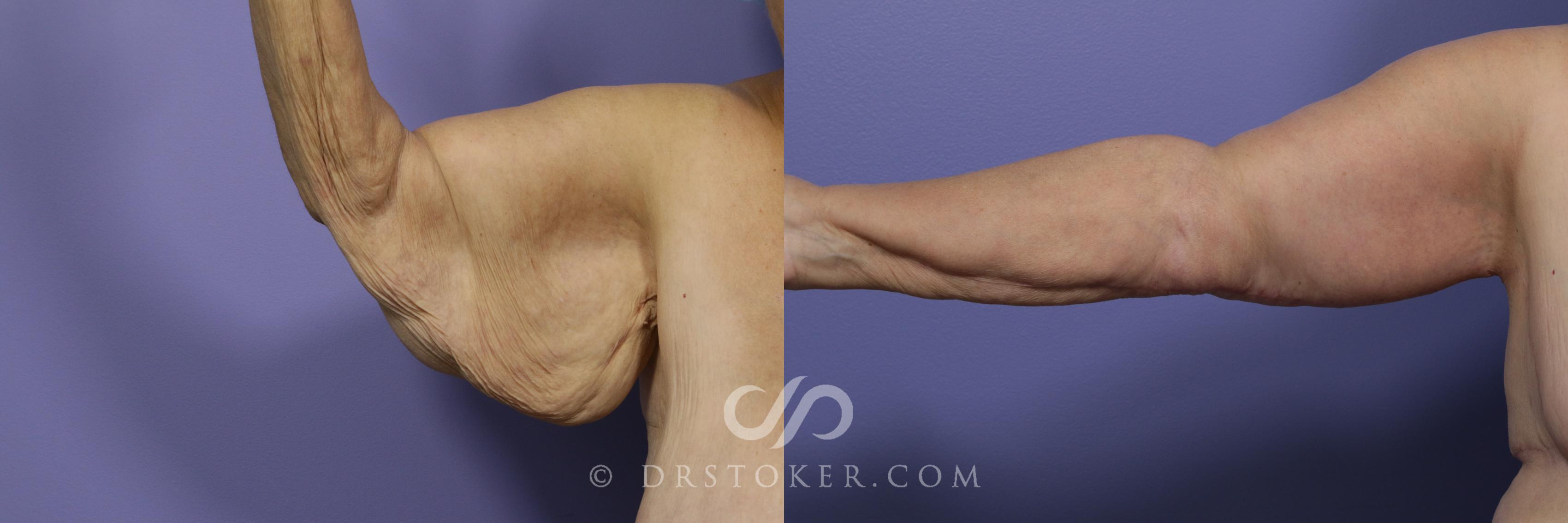 Before & After Arm Lift Case 1151 View #1 View in Los Angeles, CA