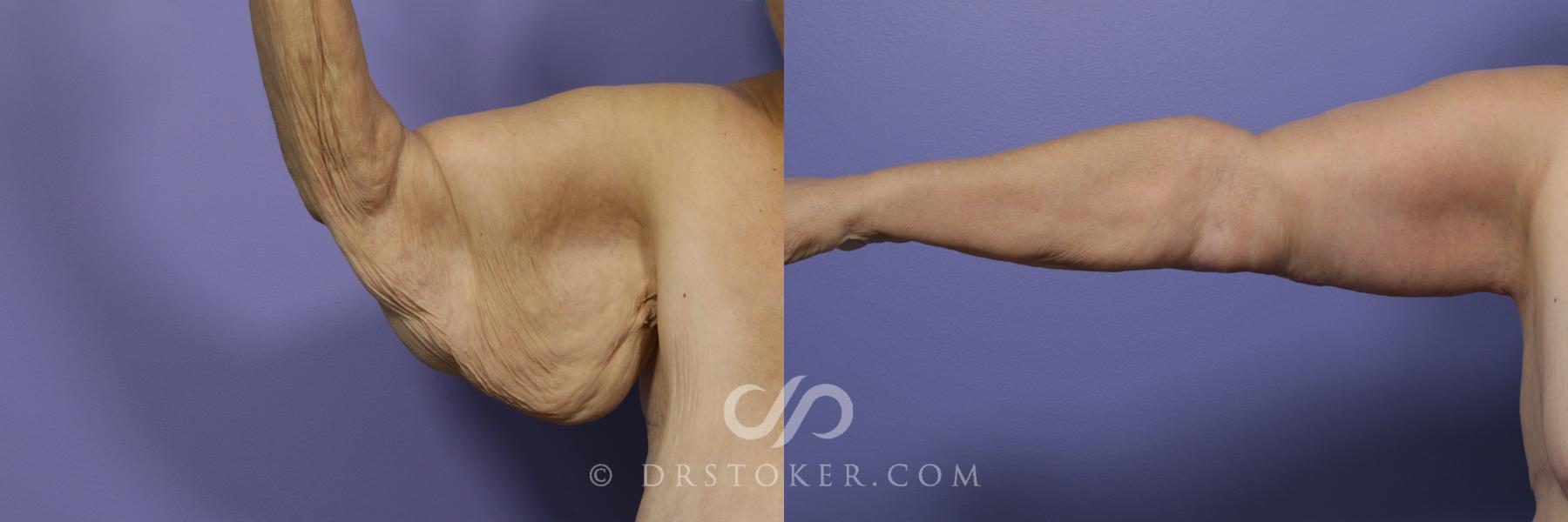 Before & After Arm Lift Case 1151 View #2 View in Los Angeles, CA