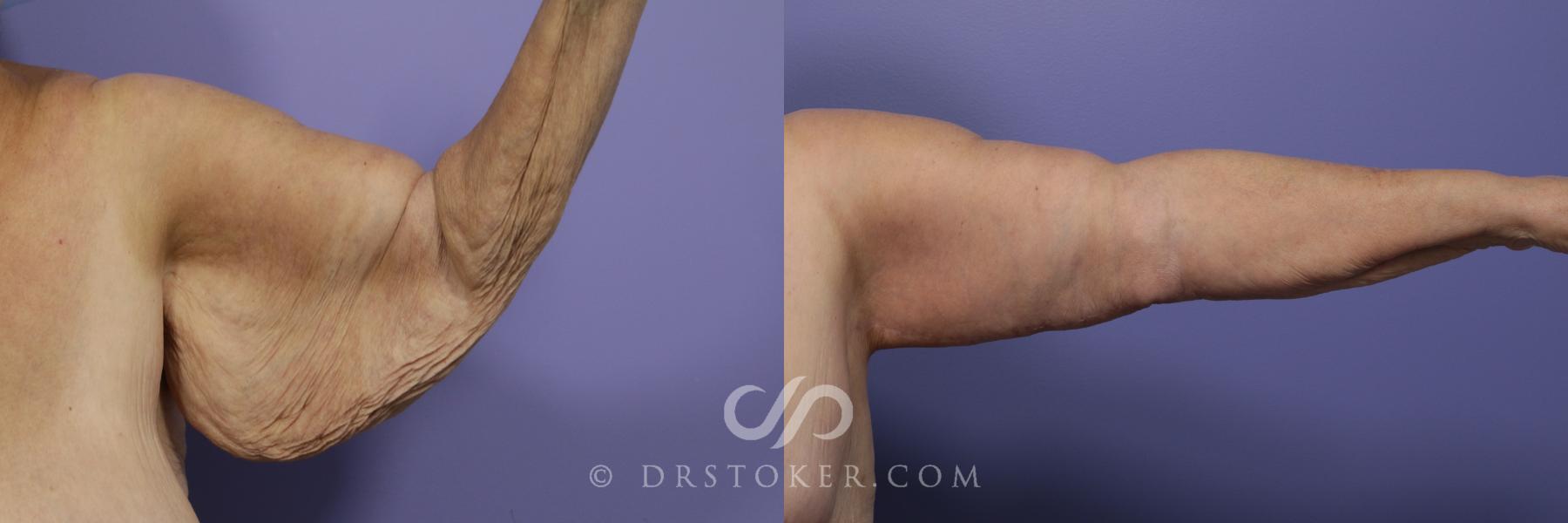 Before & After Arm Lift Case 1152 View #2 View in Los Angeles, CA