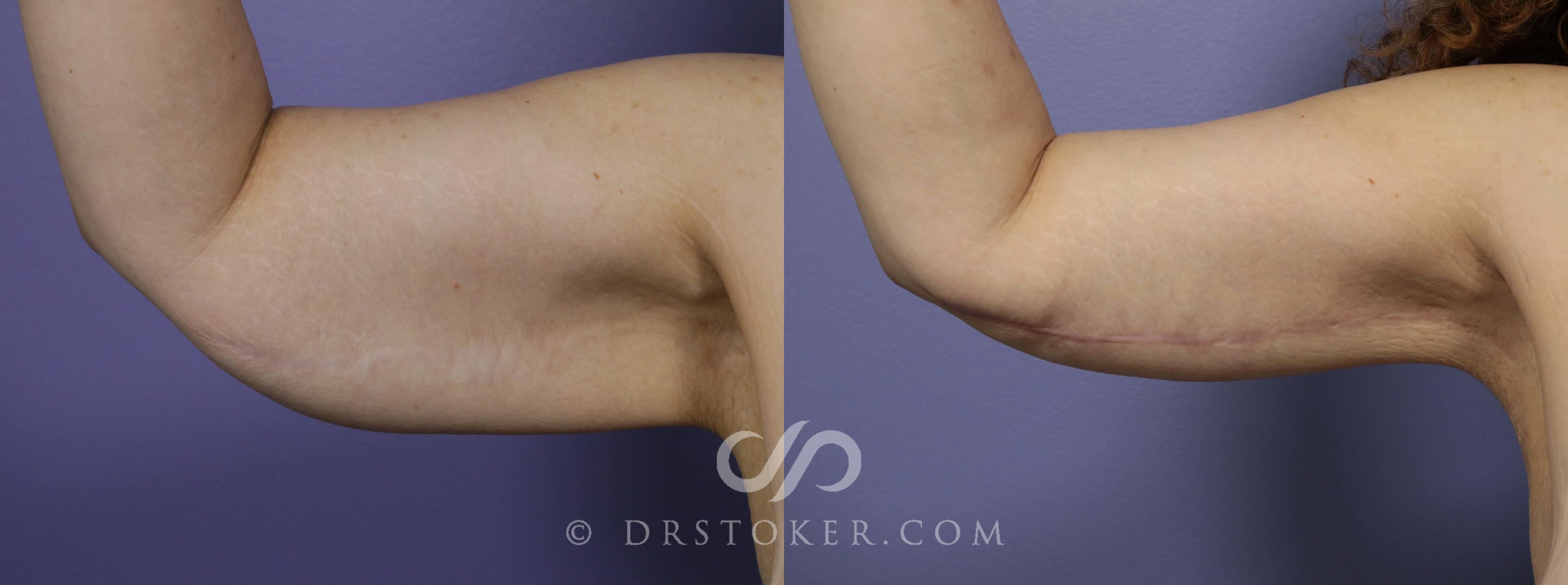 Before & After Arm Lift Case 1153 View #1 View in Los Angeles, CA