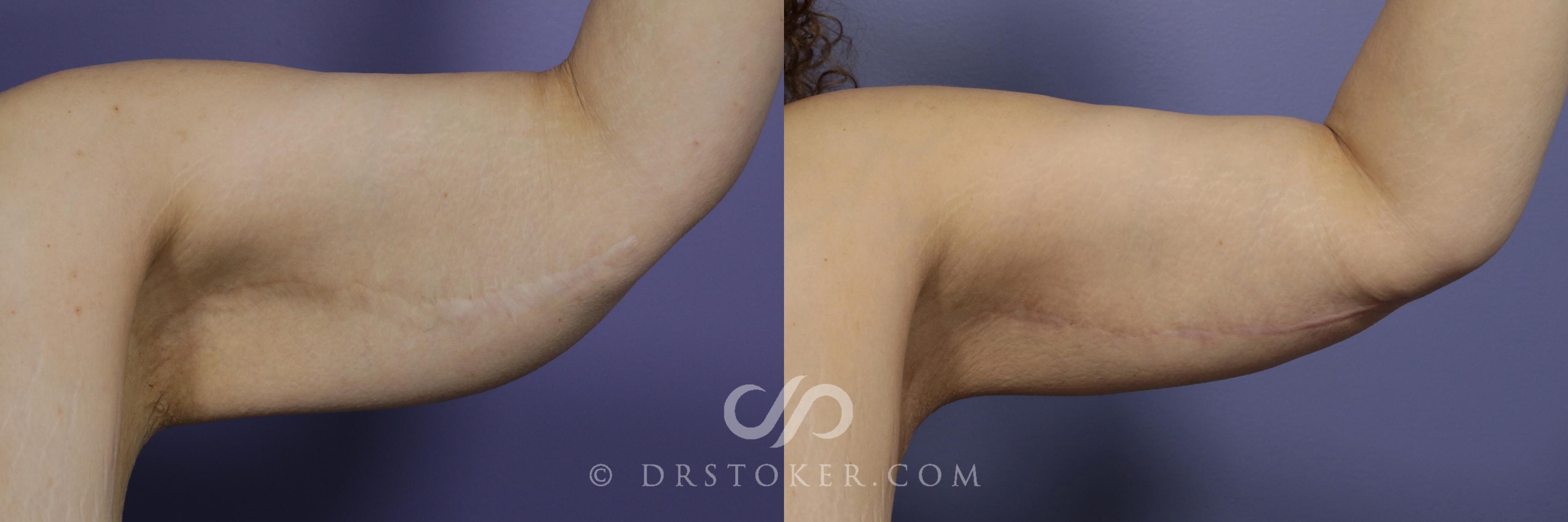 Before & After Arm Lift Case 1154 View #1 View in Los Angeles, CA