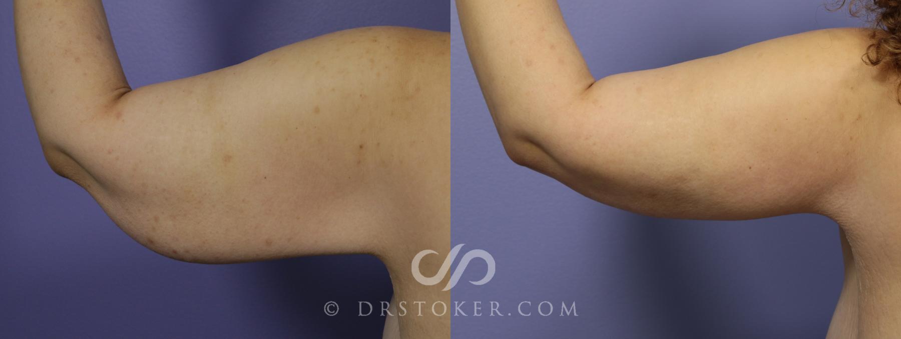 Before & After Arm Lift Case 1155 View #1 View in Los Angeles, CA