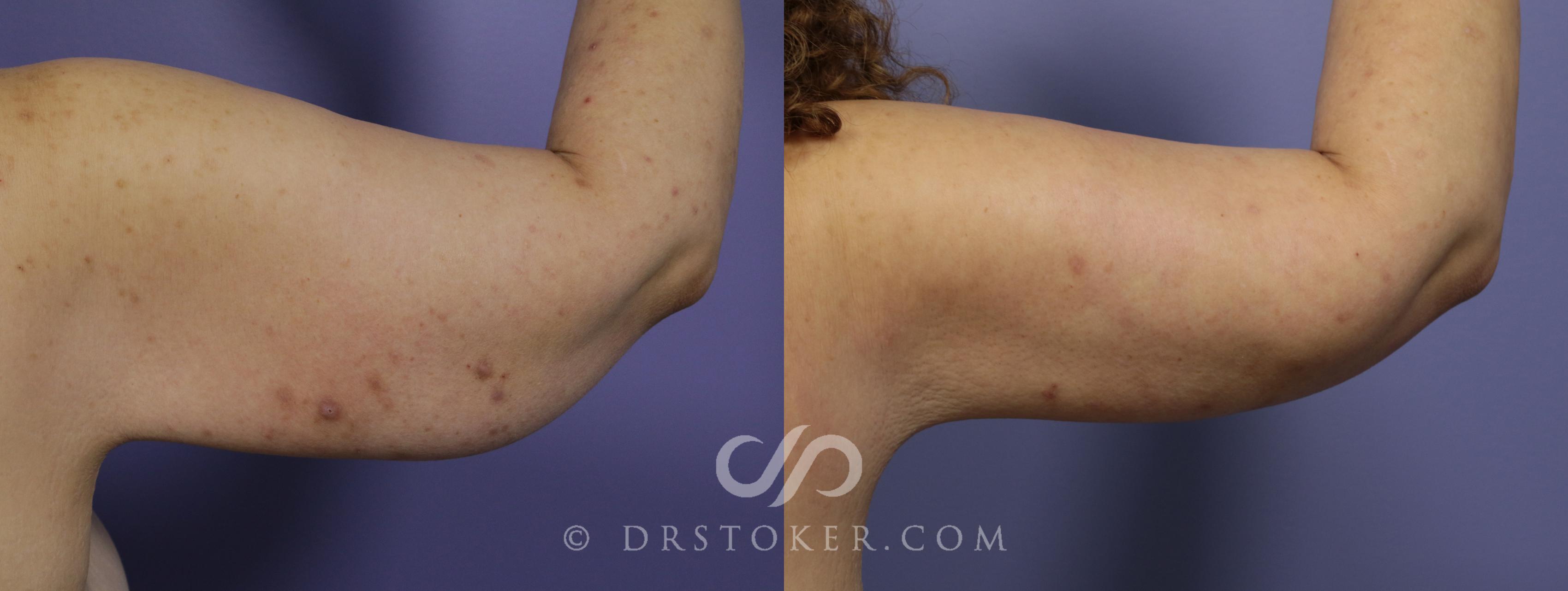 Before & After Arm Lift Case 1156 View #1 View in Los Angeles, CA