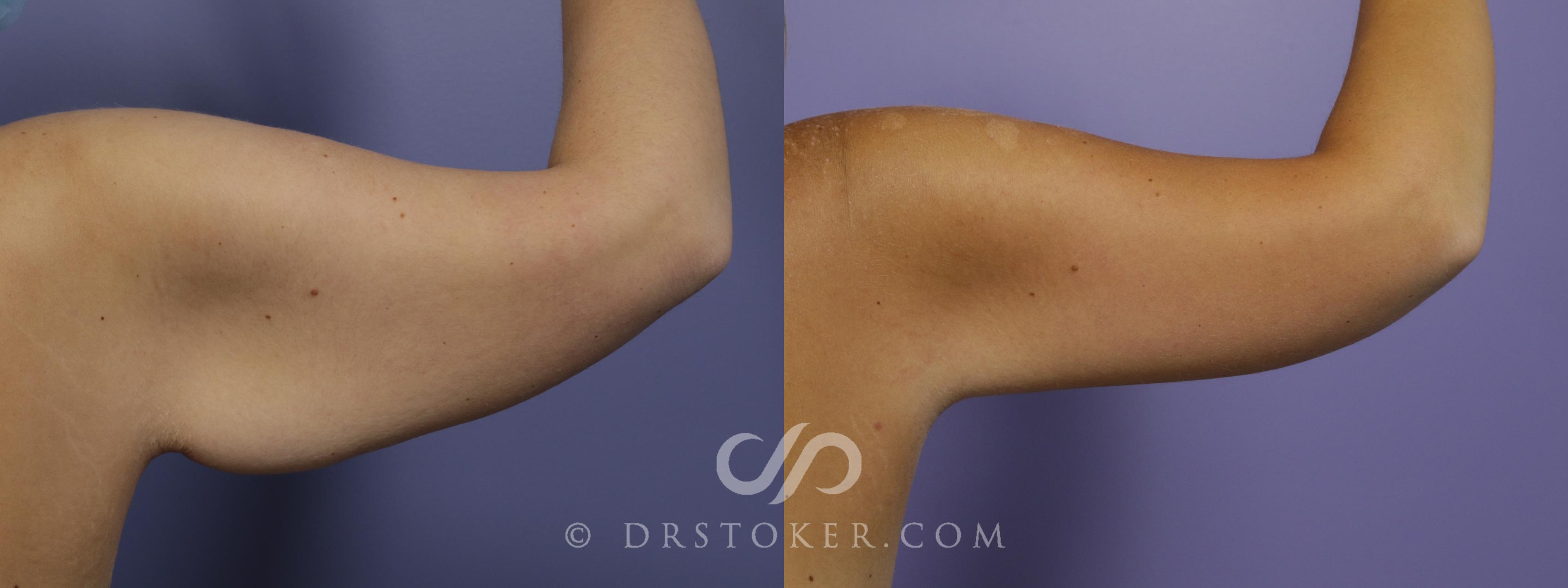 Before & After Arm Lift Case 1377 View #1 View in Los Angeles, CA